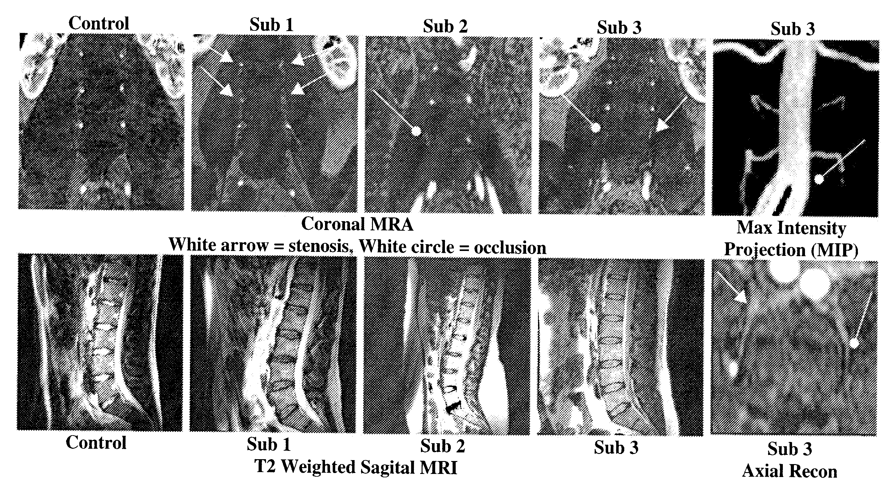 Therapeutic angiogenesis for treatment of the spine