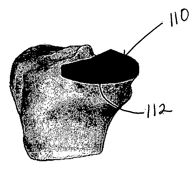 Method and system for joint repair