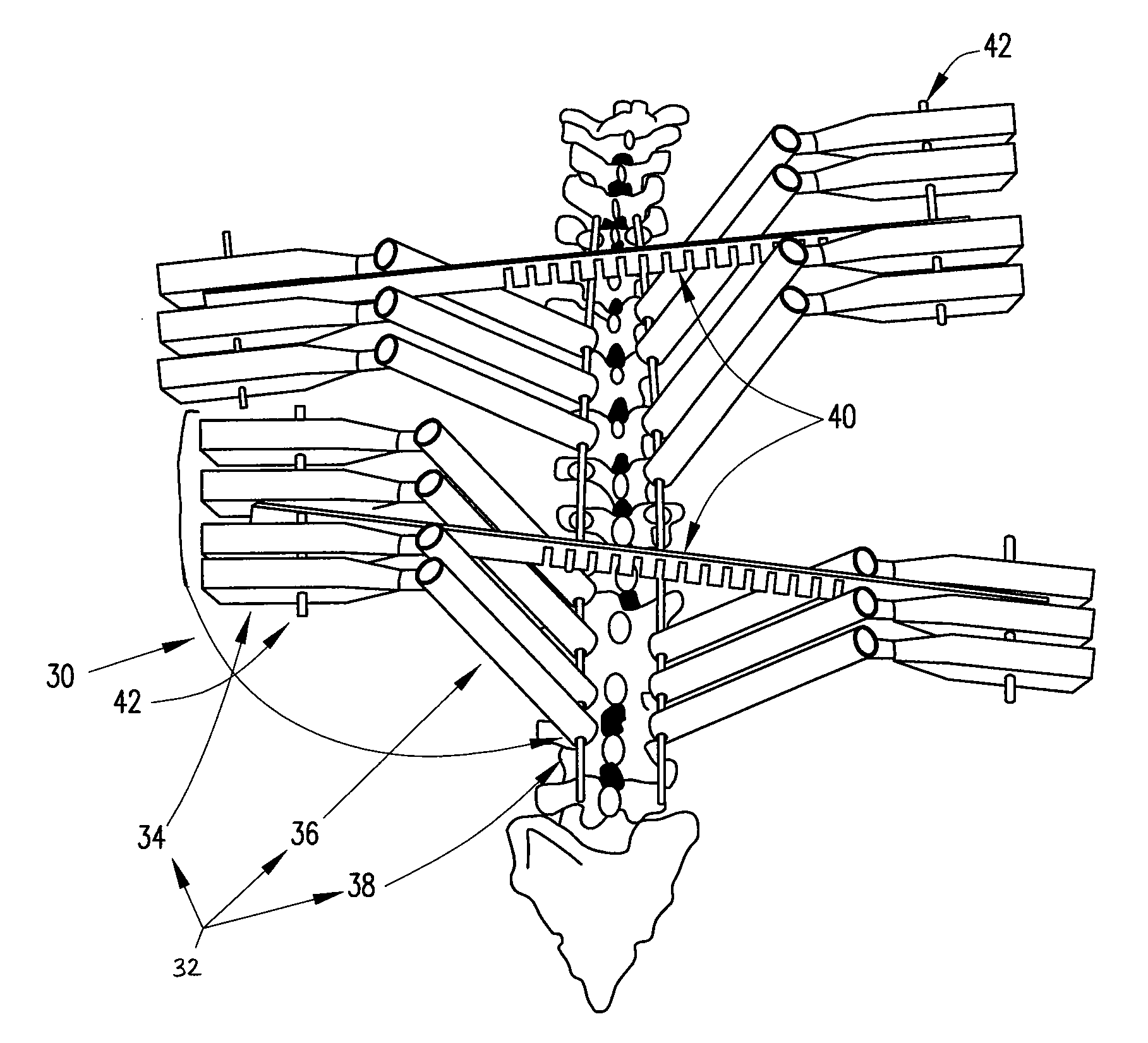 System and method for aligning vertebrae in the amelioration of aberrant spinal column deviation conditions