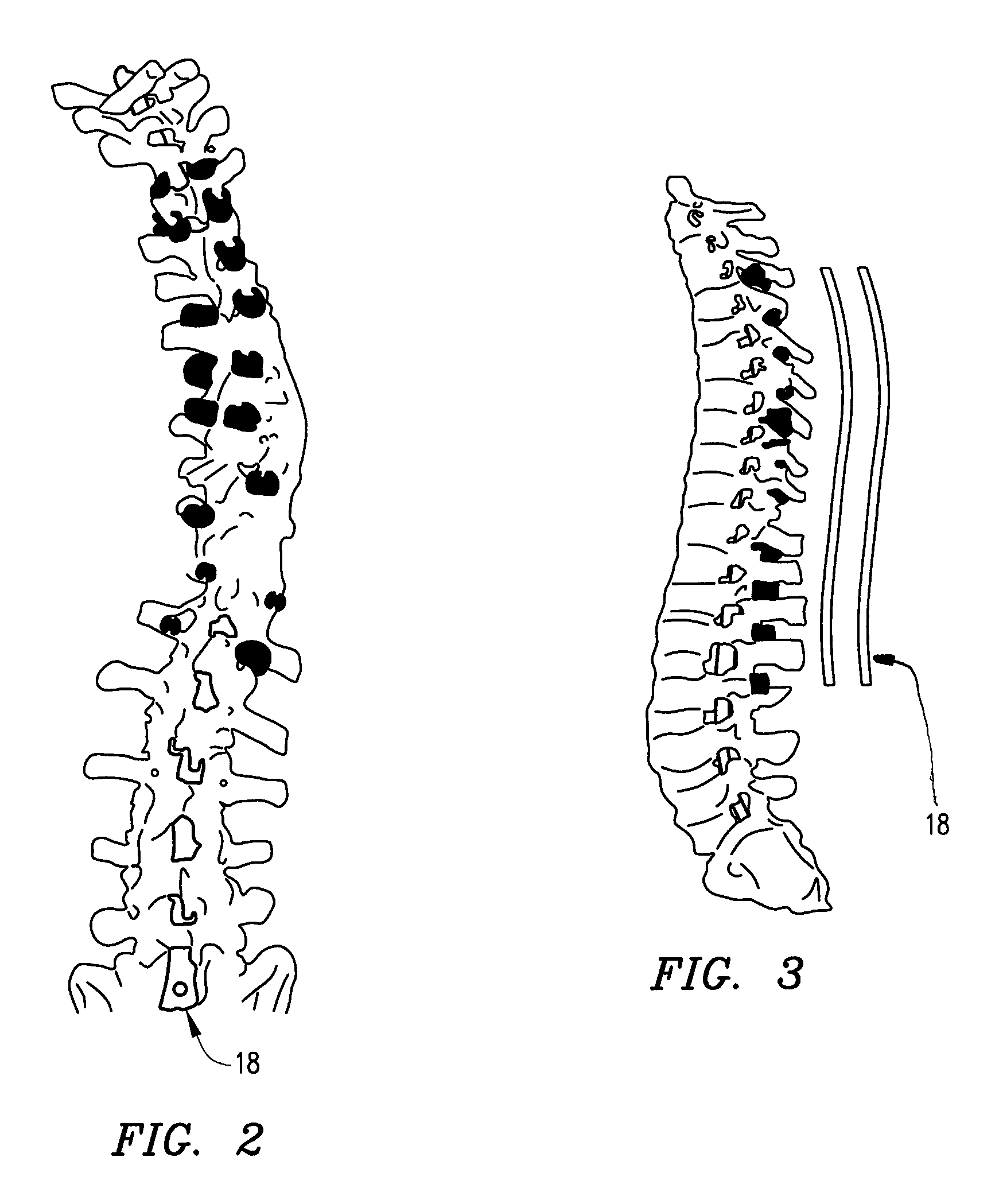 System and method for aligning vertebrae in the amelioration of aberrant spinal column deviation conditions