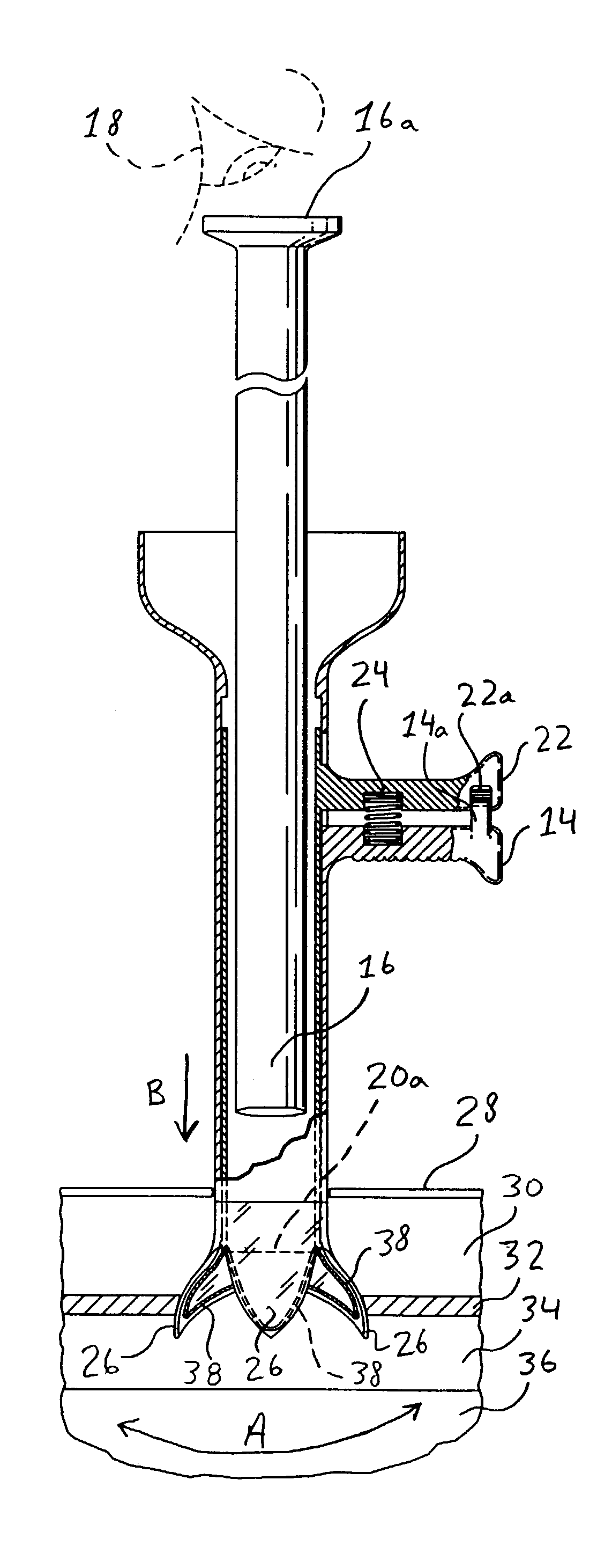 Laparoscopic direct vision dissecting port