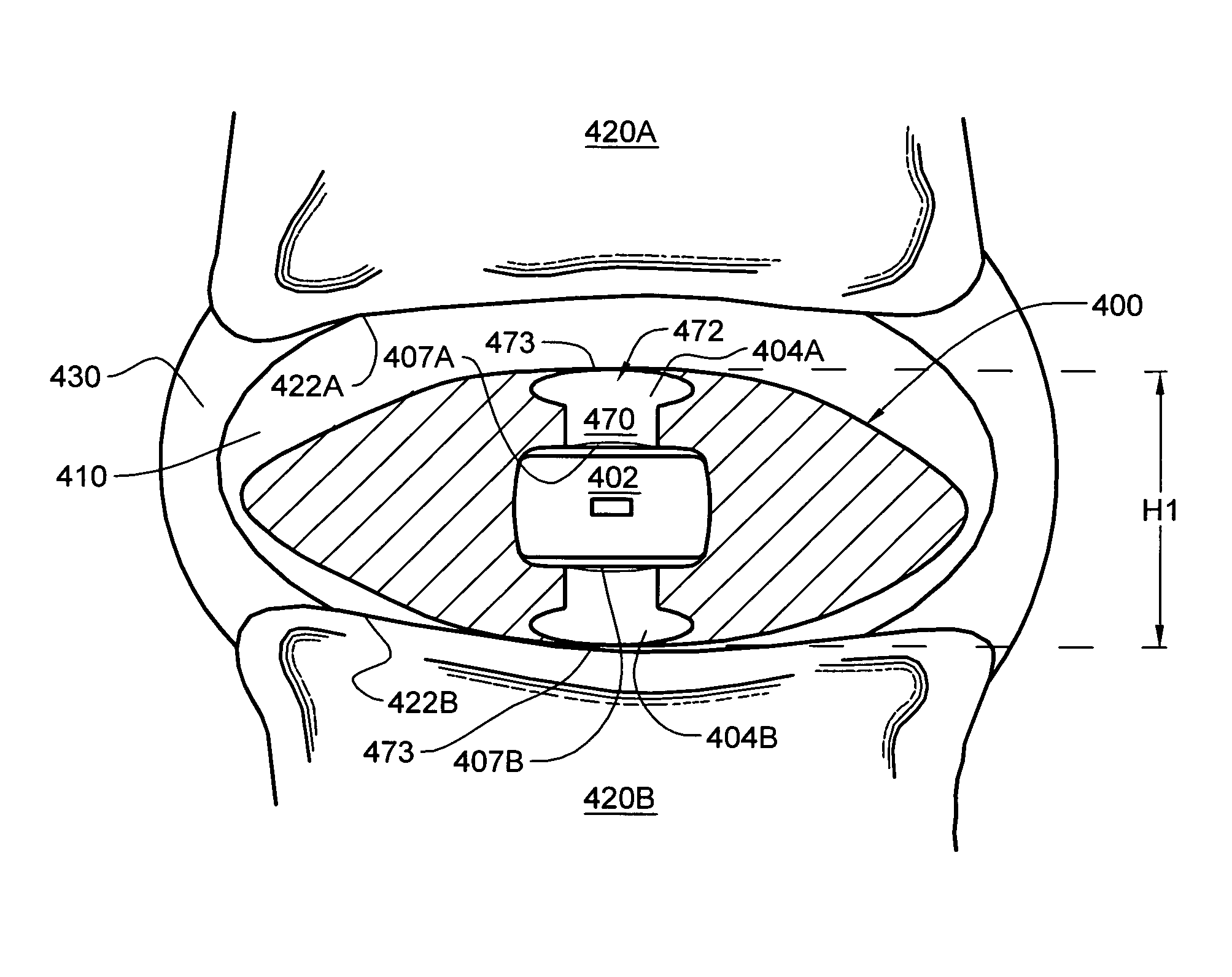 Intervertebral disc nucleus replacement implants and methods