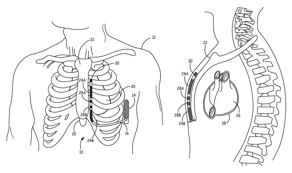 Implantable extravascular electrical stimulation lead having improved sensing and pacing capability