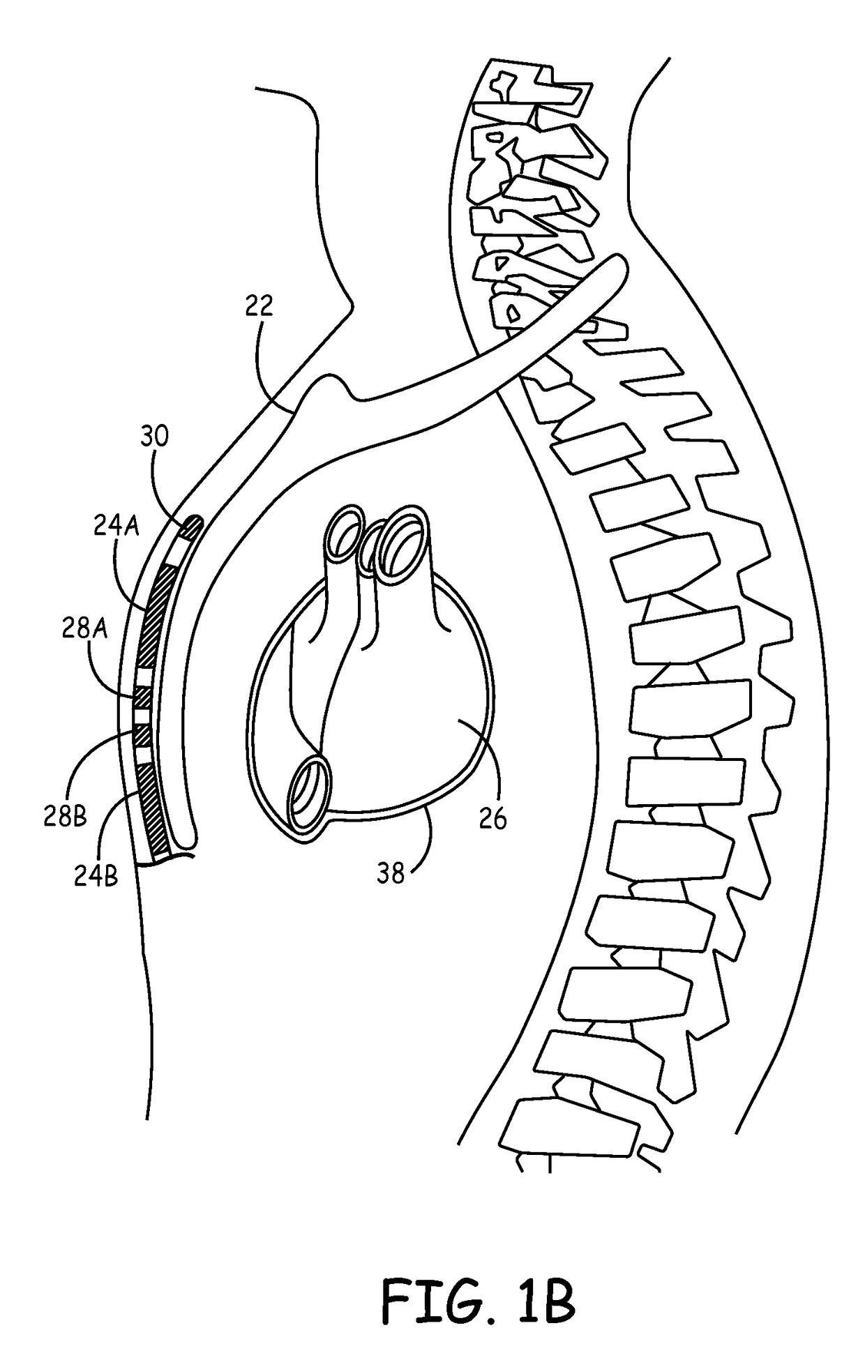 Implantable extravascular electrical stimulation lead having improved sensing and pacing capability