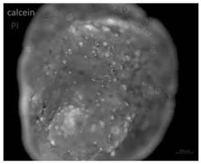 Culture method for colorectal cancer organoids and culture solution