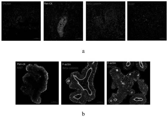 Culture method for colorectal cancer organoids and culture solution