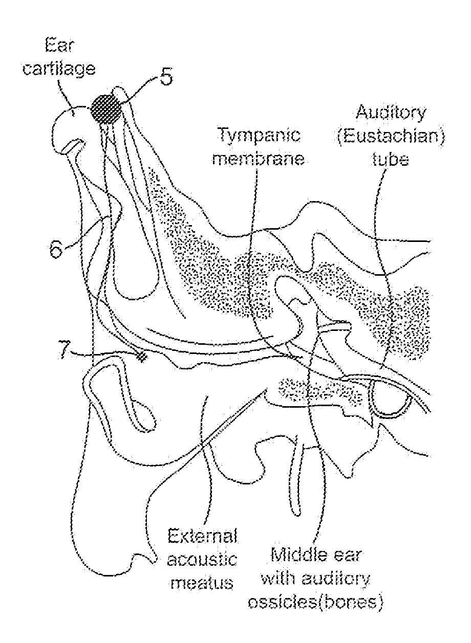 Bone conduction hearing device with open-ear microphone