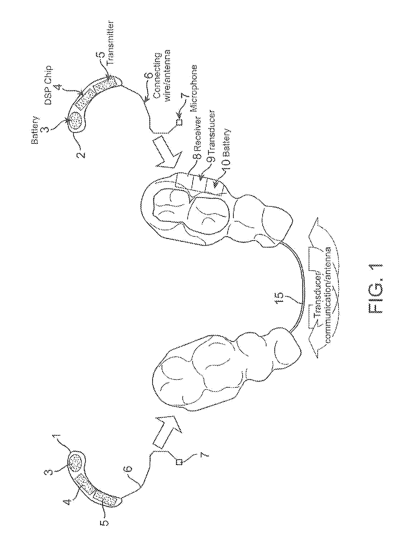 Bone conduction hearing device with open-ear microphone