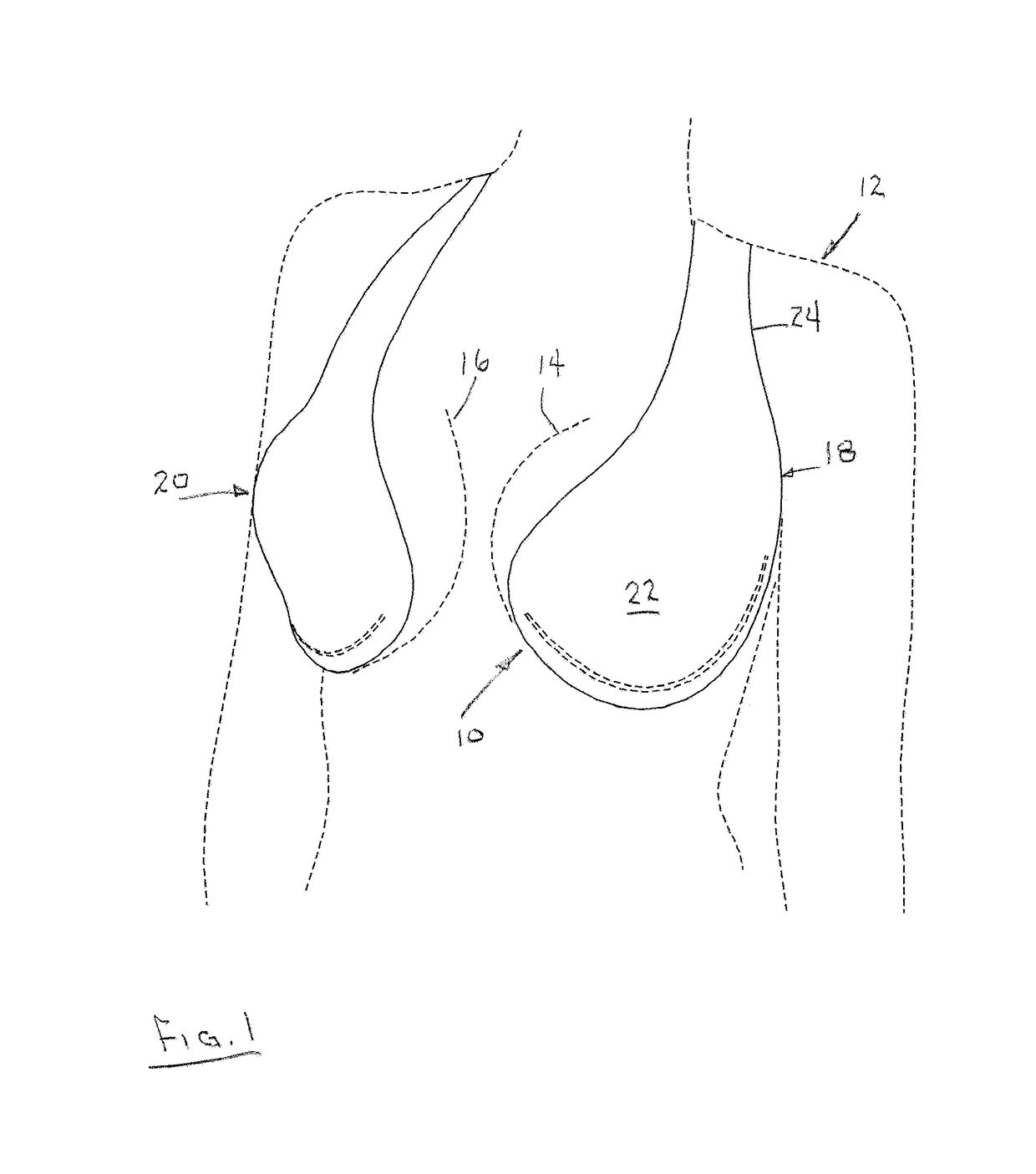 Adhesive Bra Construction Including Vertical Support Strap