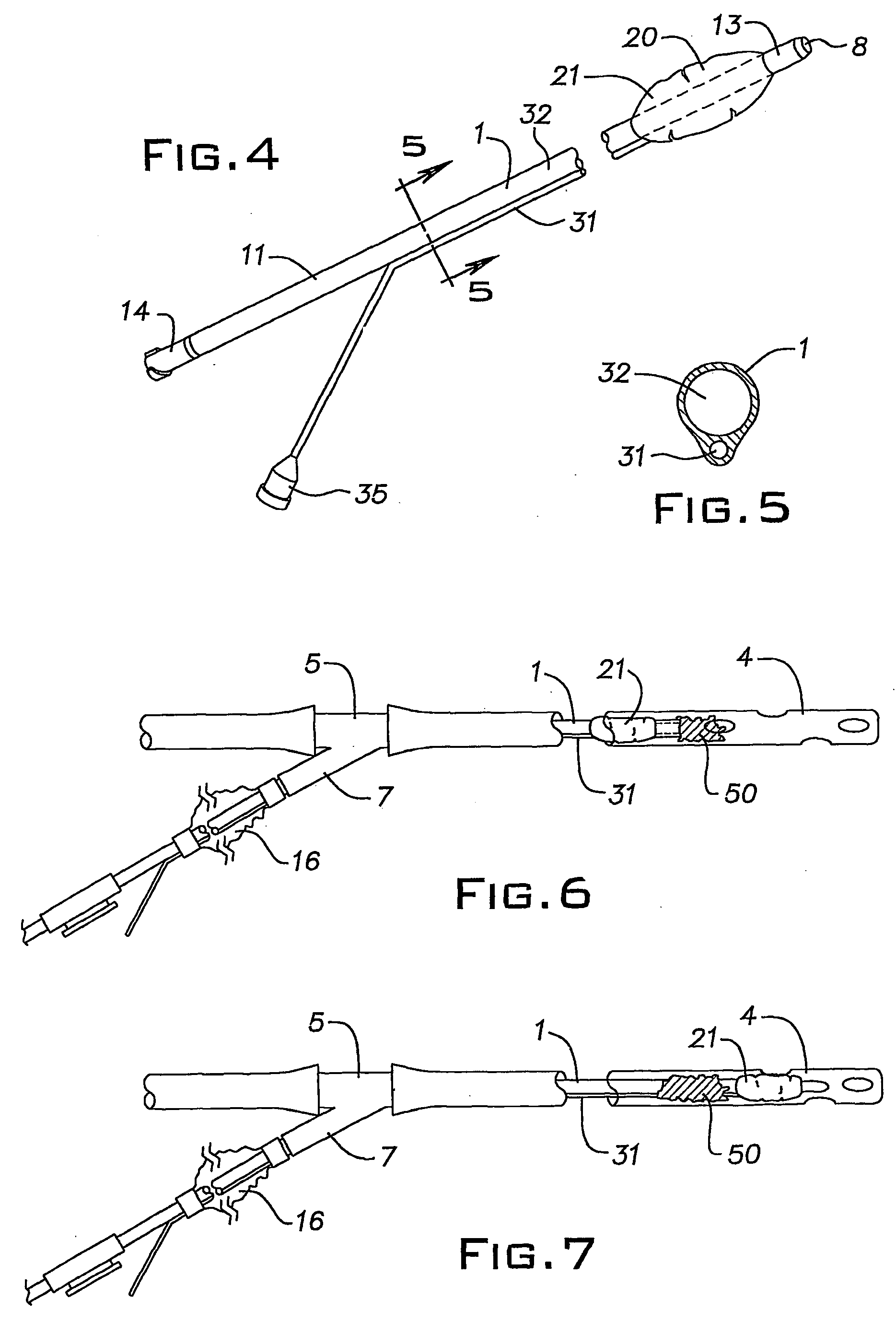 Catheter for removal of solids from surgical drains