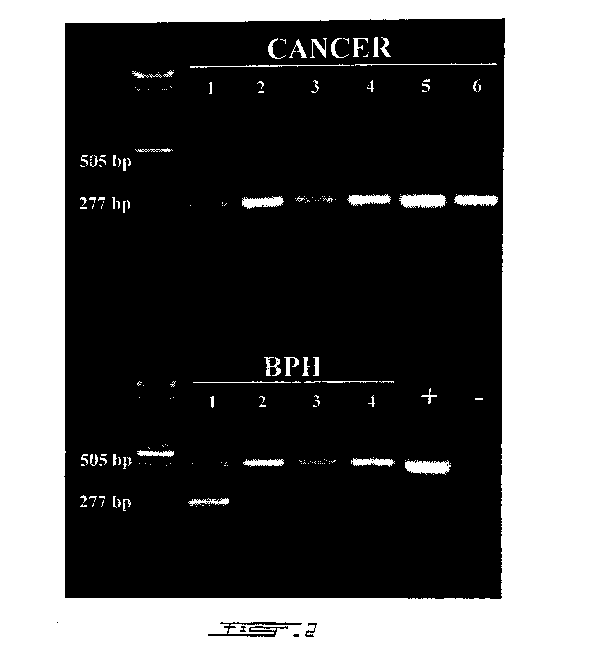 PCA3 Messenger RNA Species in Benign and Malignant Prostate Tissues