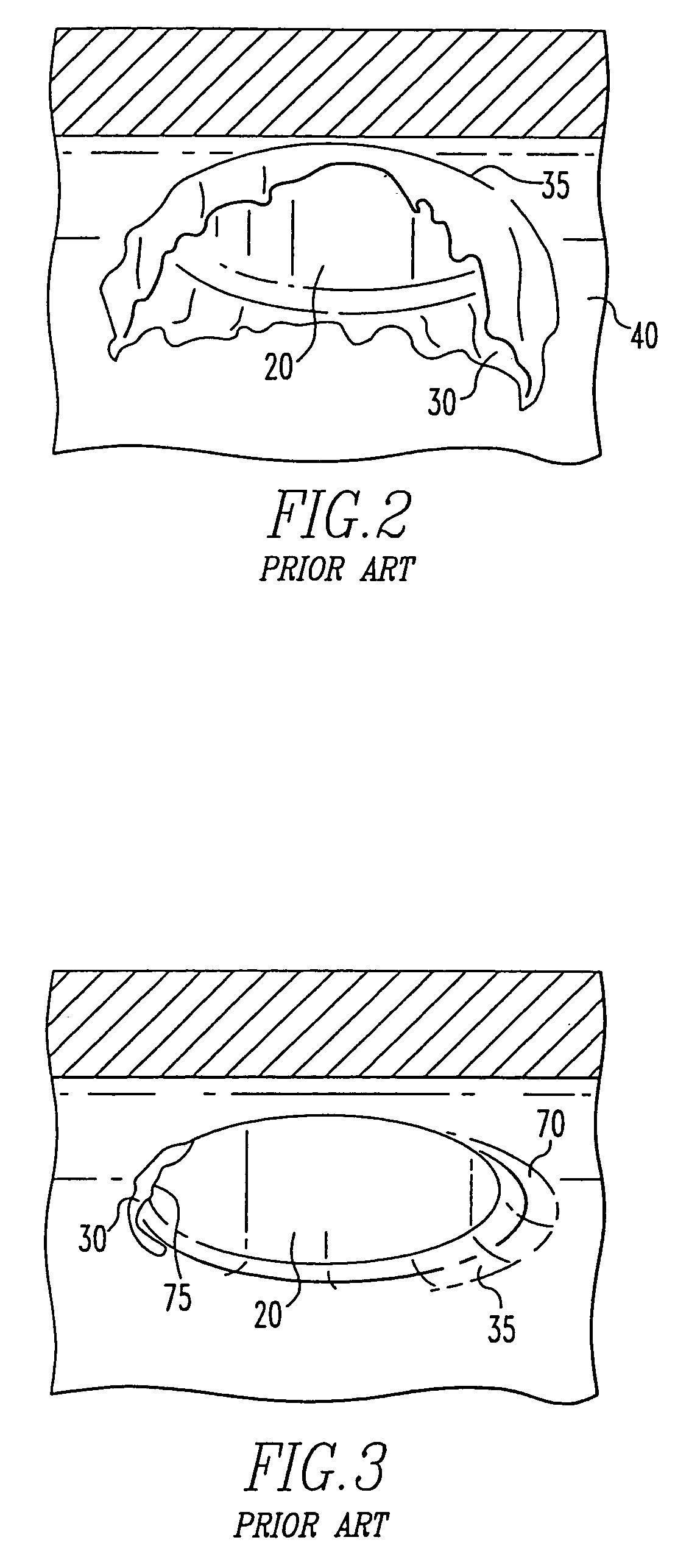 Apparatus for abrading the region of intersection between a branch outlet and a passageway in a body