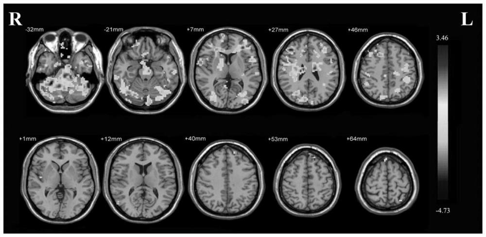 Method for extracting related posterior cingutate function connectivity characteristics of type 2 diabetes patient with cognitive impairment