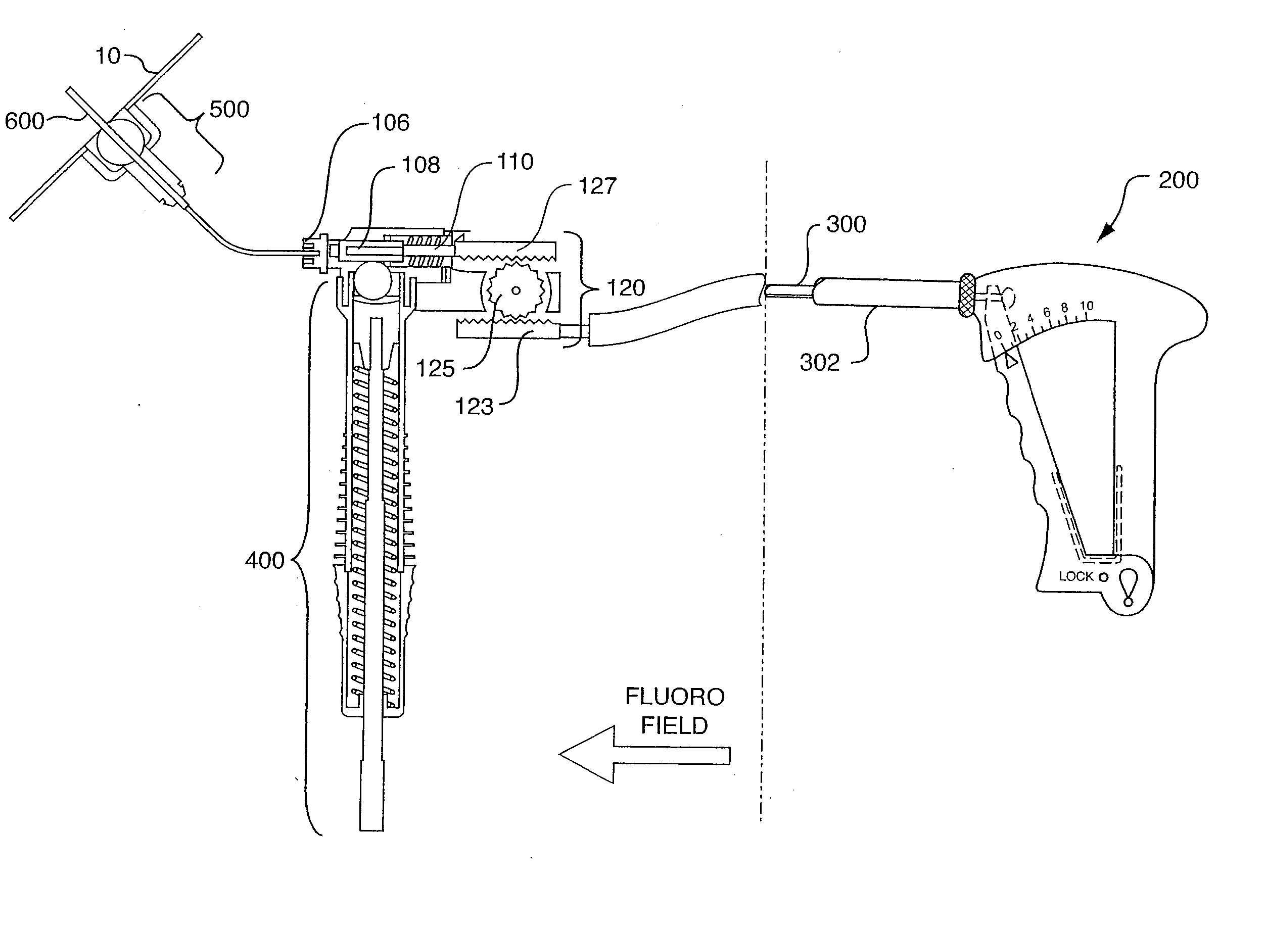 Remotely-activated vertebroplasty injection device