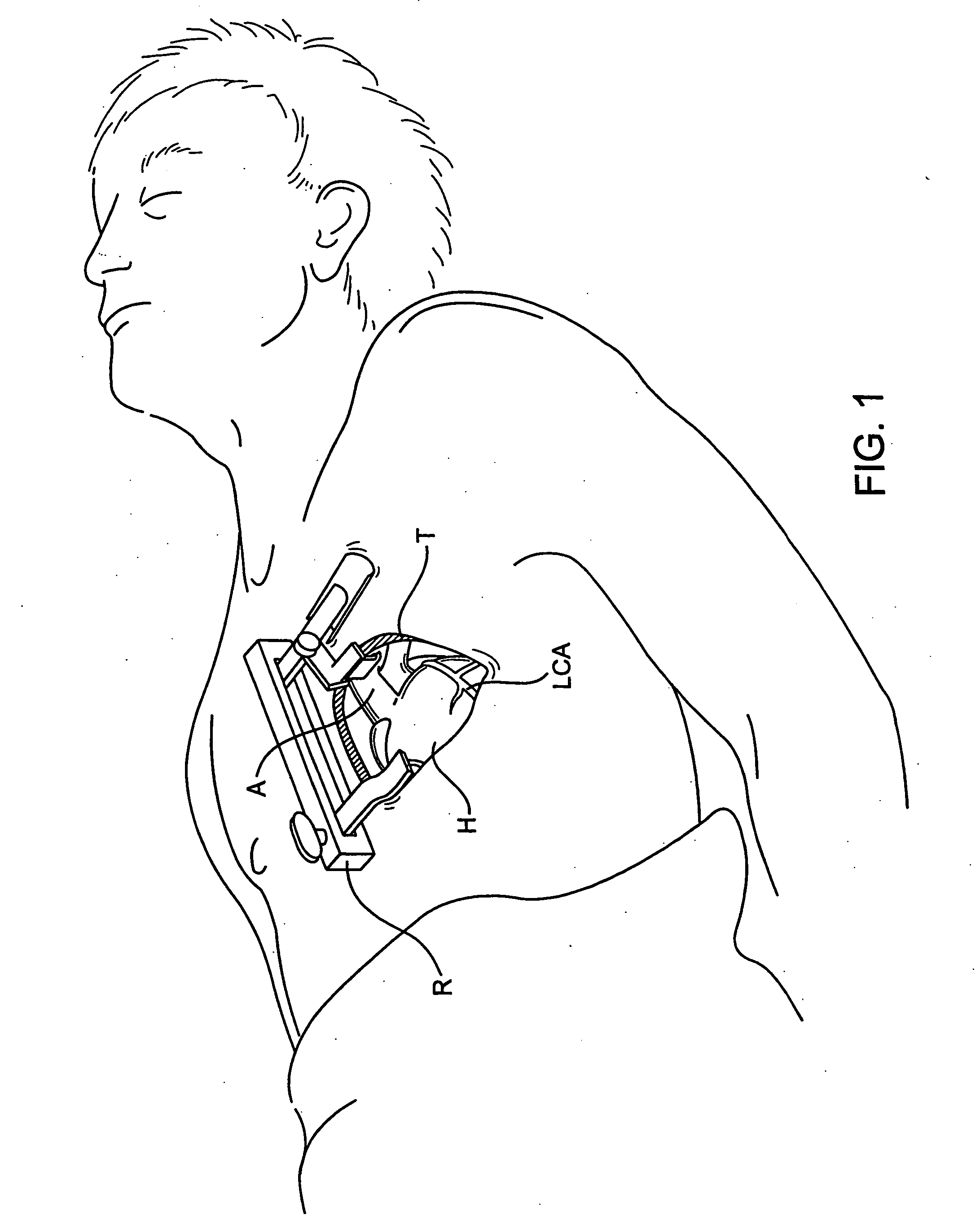 Delivering a conduit into a heart wall to place a coronary vessel in communication with a heart chamber and removing tissue from the vessel or heart wall to facilitate such communication