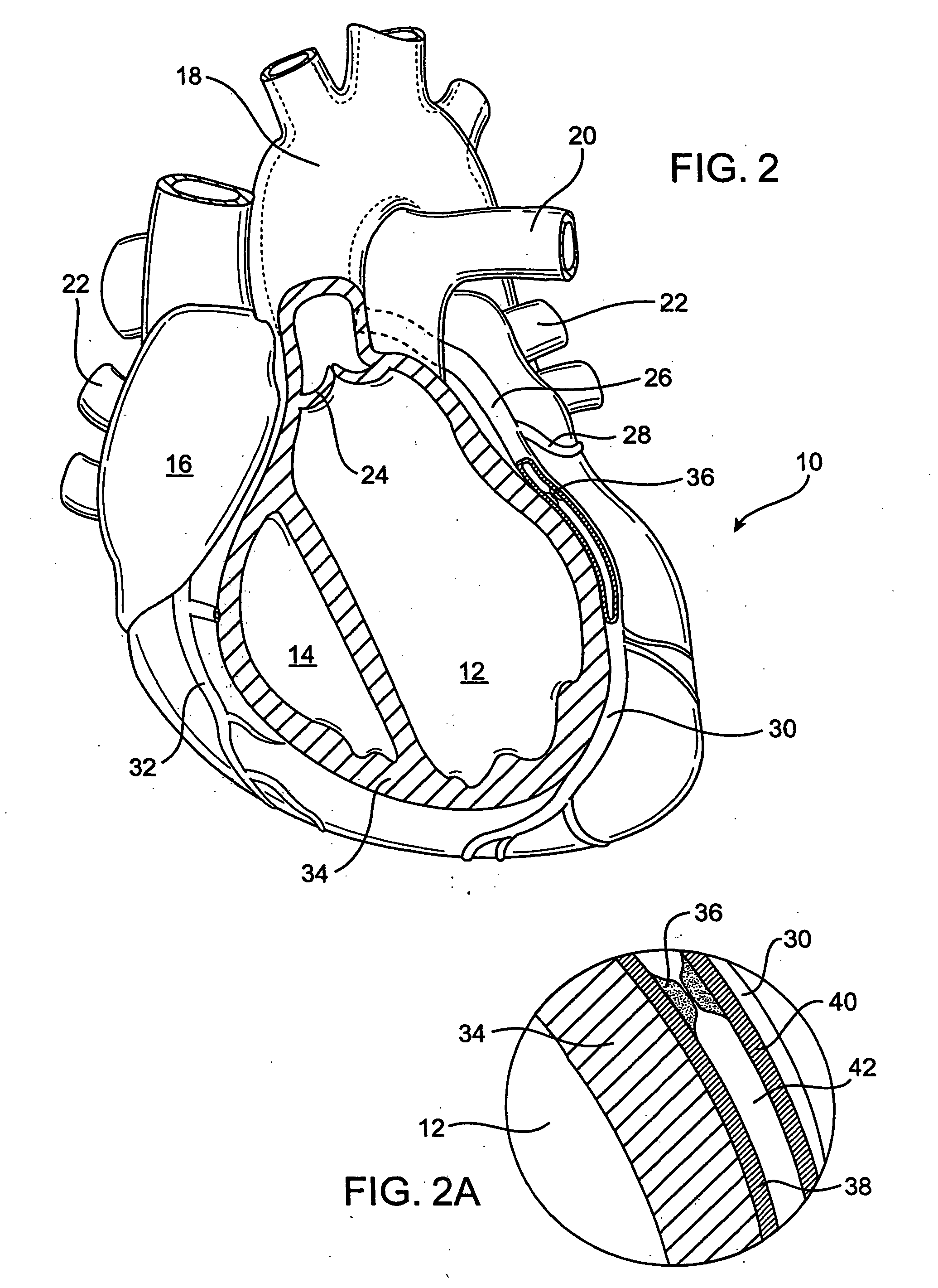 Delivering a conduit into a heart wall to place a coronary vessel in communication with a heart chamber and removing tissue from the vessel or heart wall to facilitate such communication