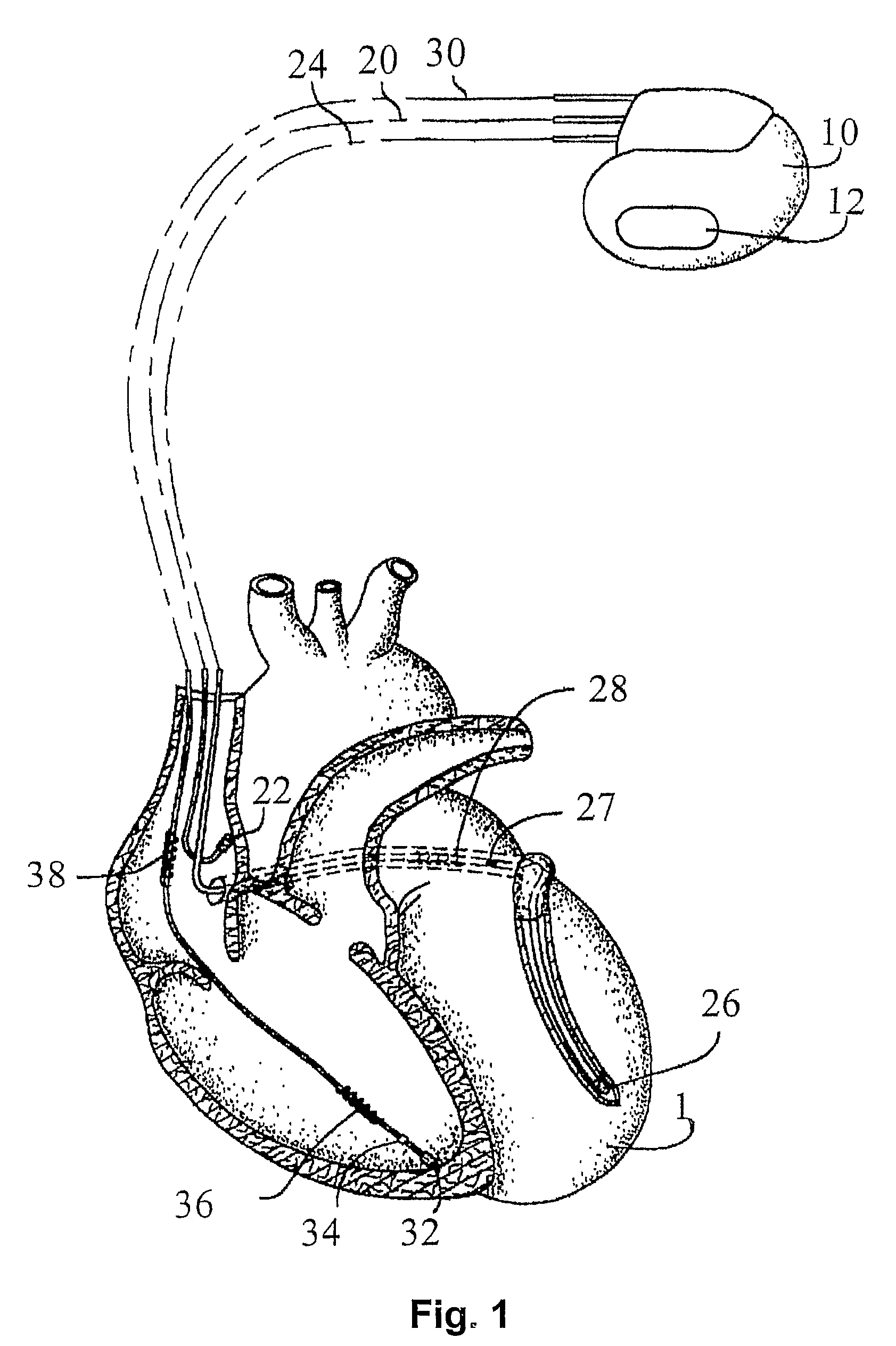 Biventricular heart stimulator and method of controlling a biventricular heart stimulator