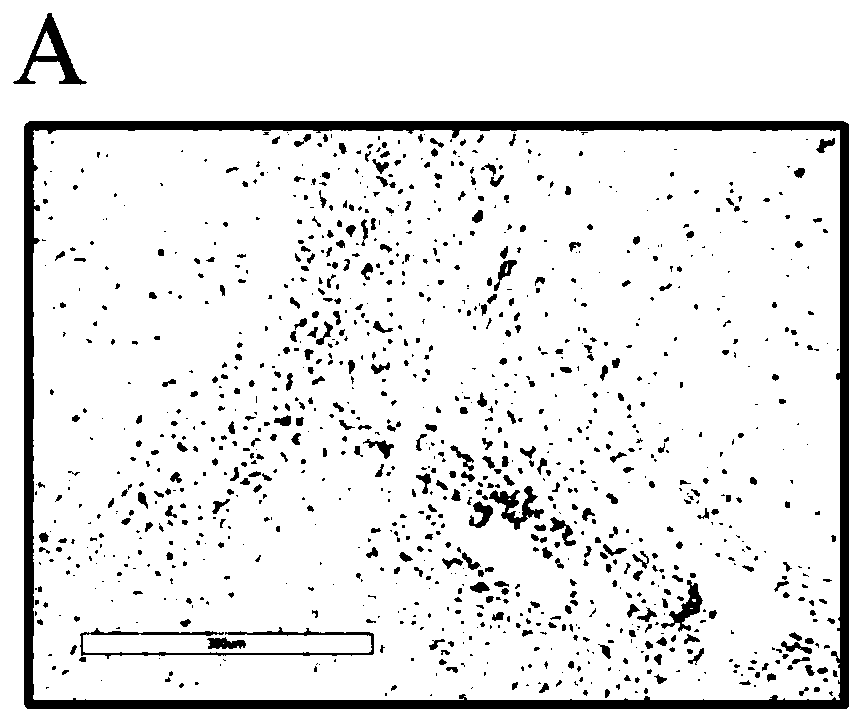 Application of a CD47 antibody in a liver cancer radiotherapy sensitivity detection kit