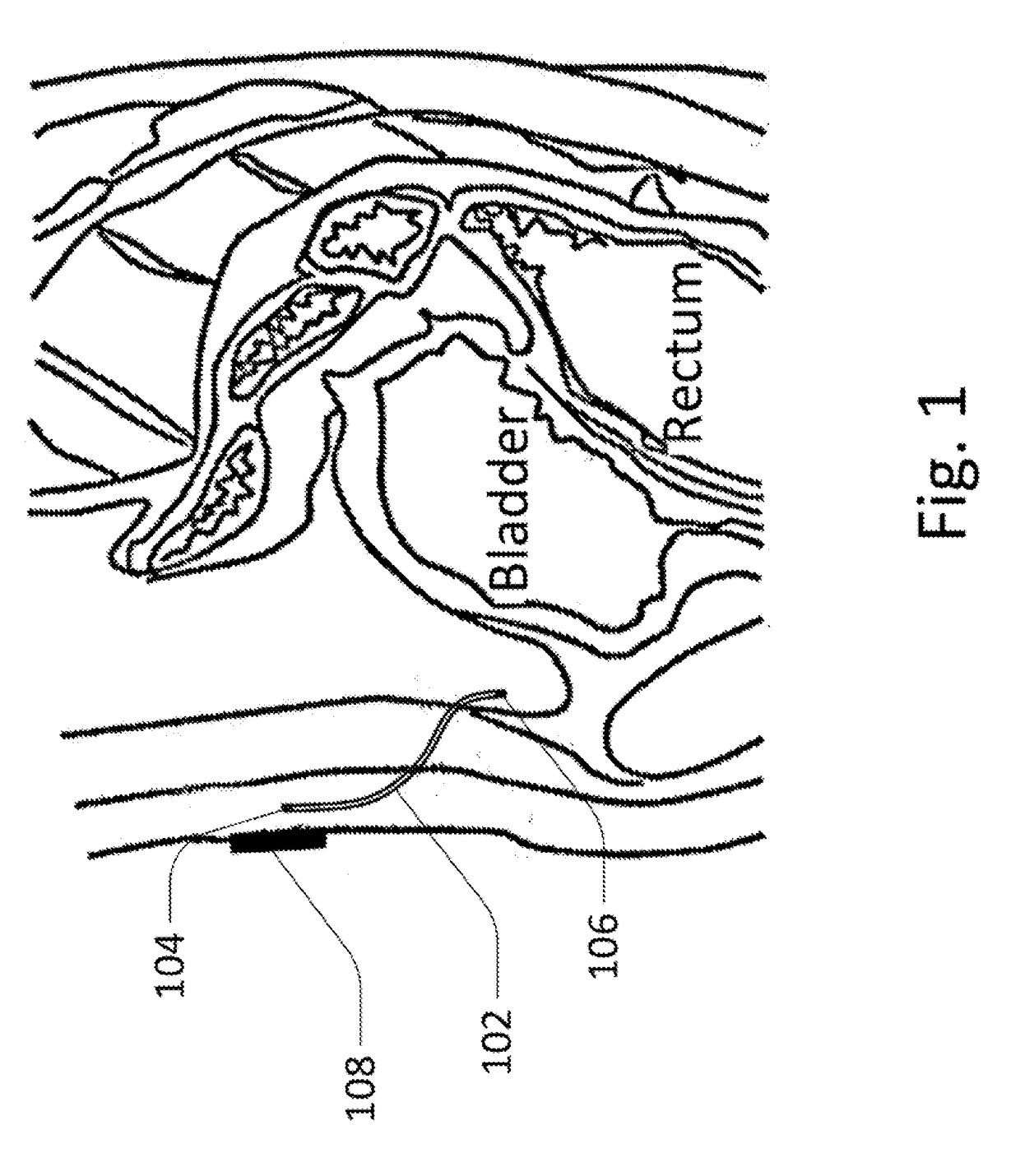 Methods and devices for analyte sensing in potential spaces