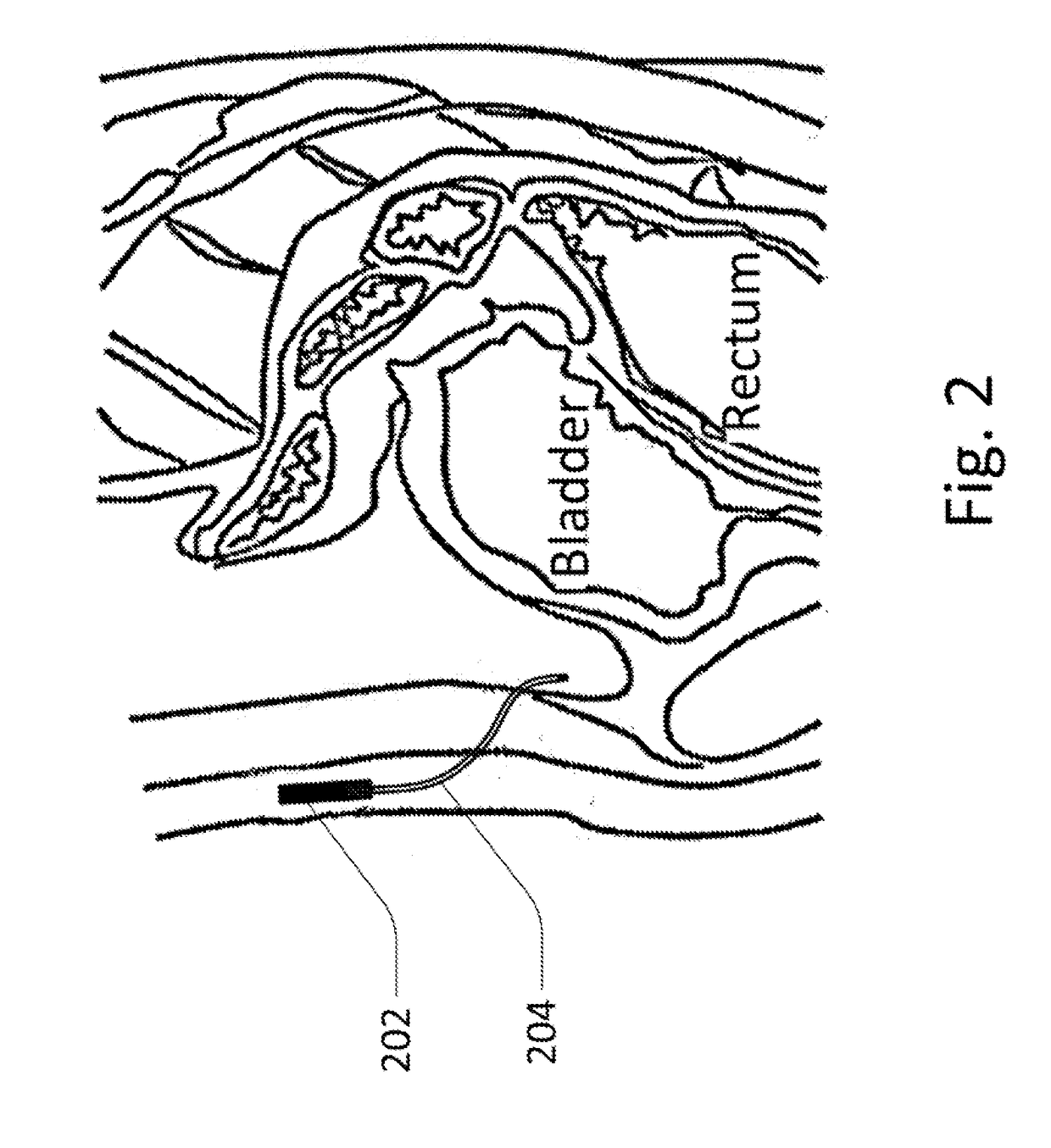 Methods and devices for analyte sensing in potential spaces