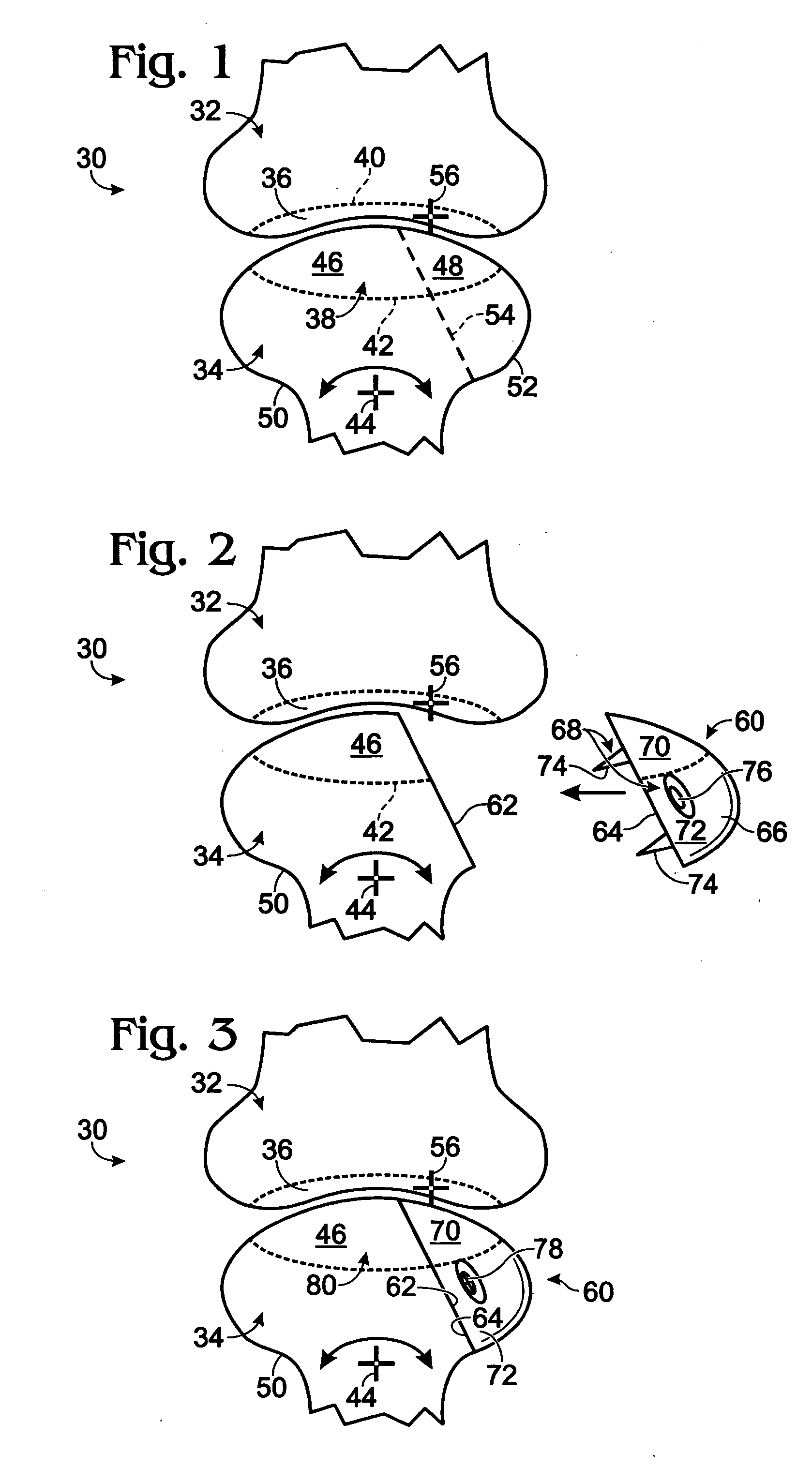 Prosthesis for partial replacement of an articulating surface on bone