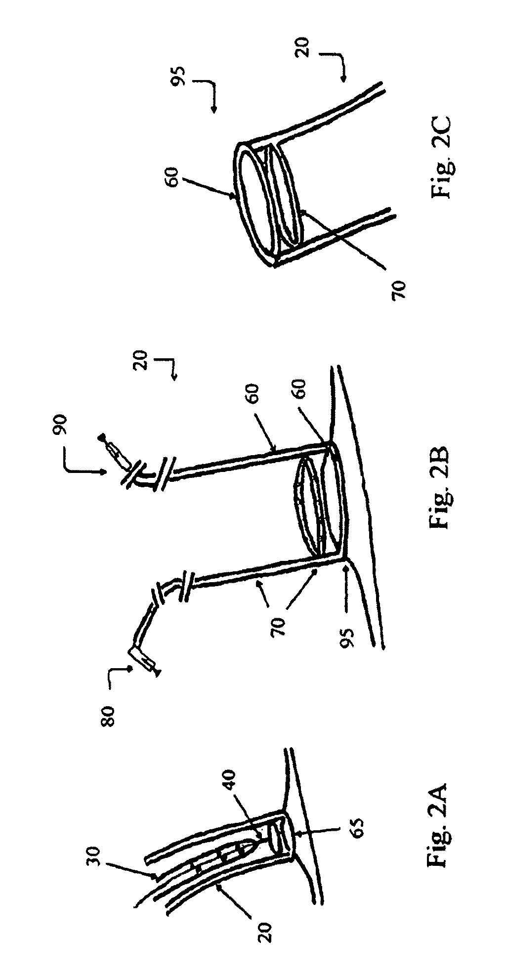 Devices, systems, and methods for promotion of infarct healing and reinforcement of border zone