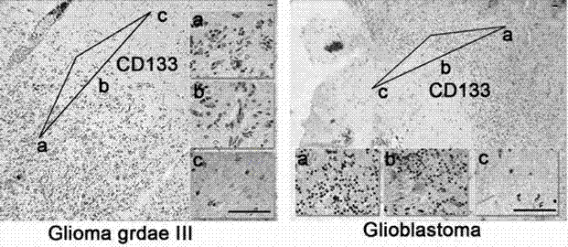 Use of CD133 in preparation of tumor marker and kit of CD133