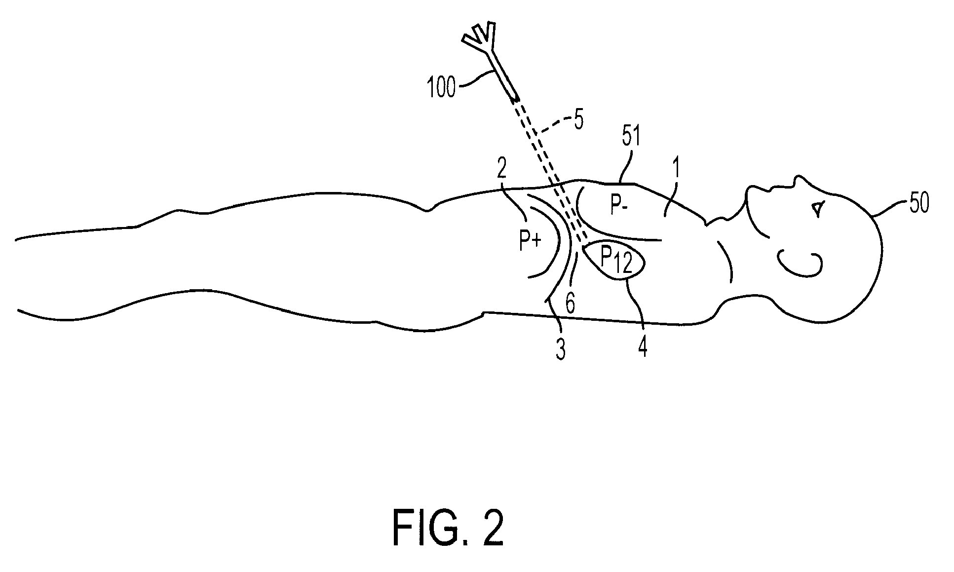 Access needle pressure sensor device and method of use