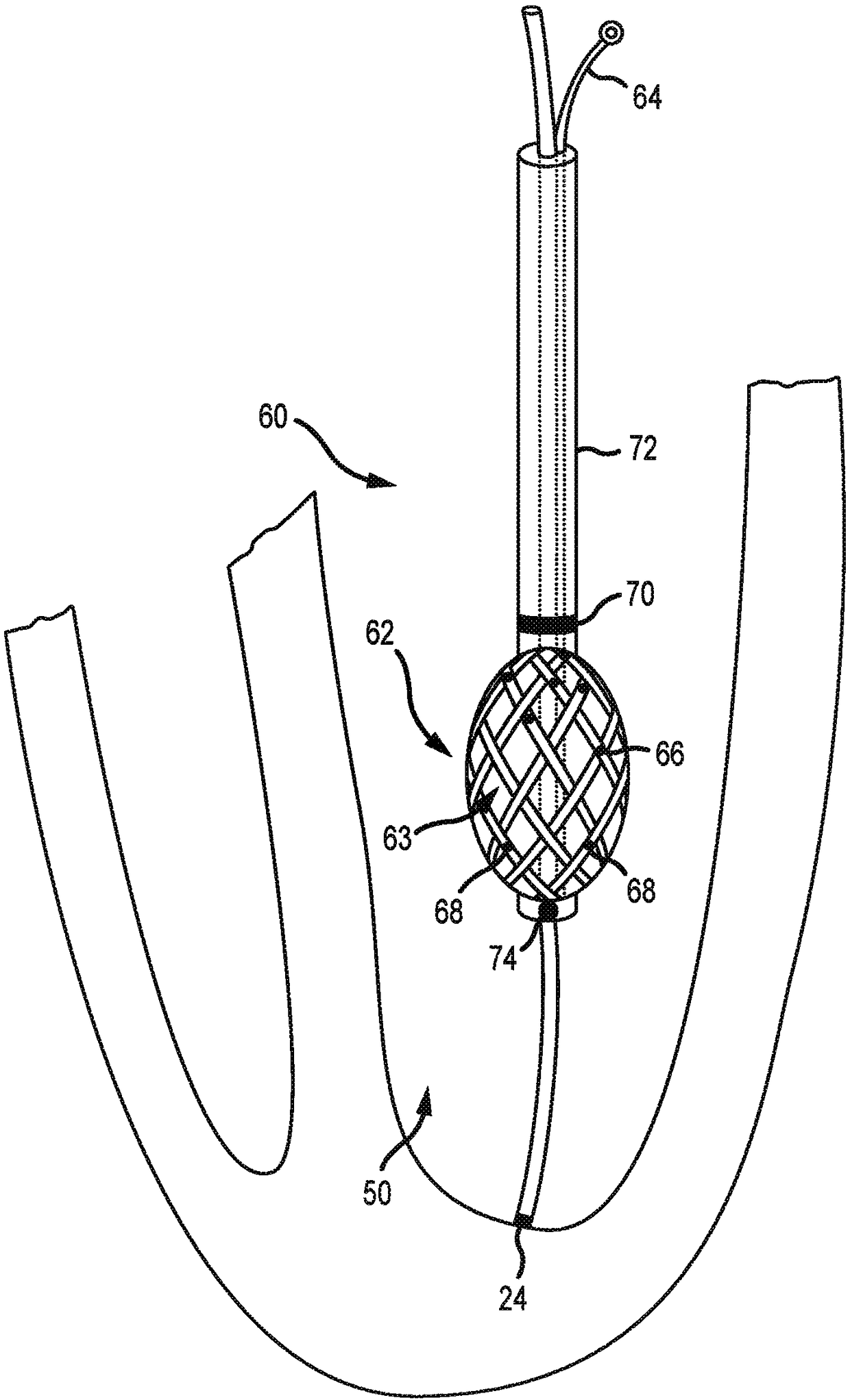 System and method for electrophysiology procedures