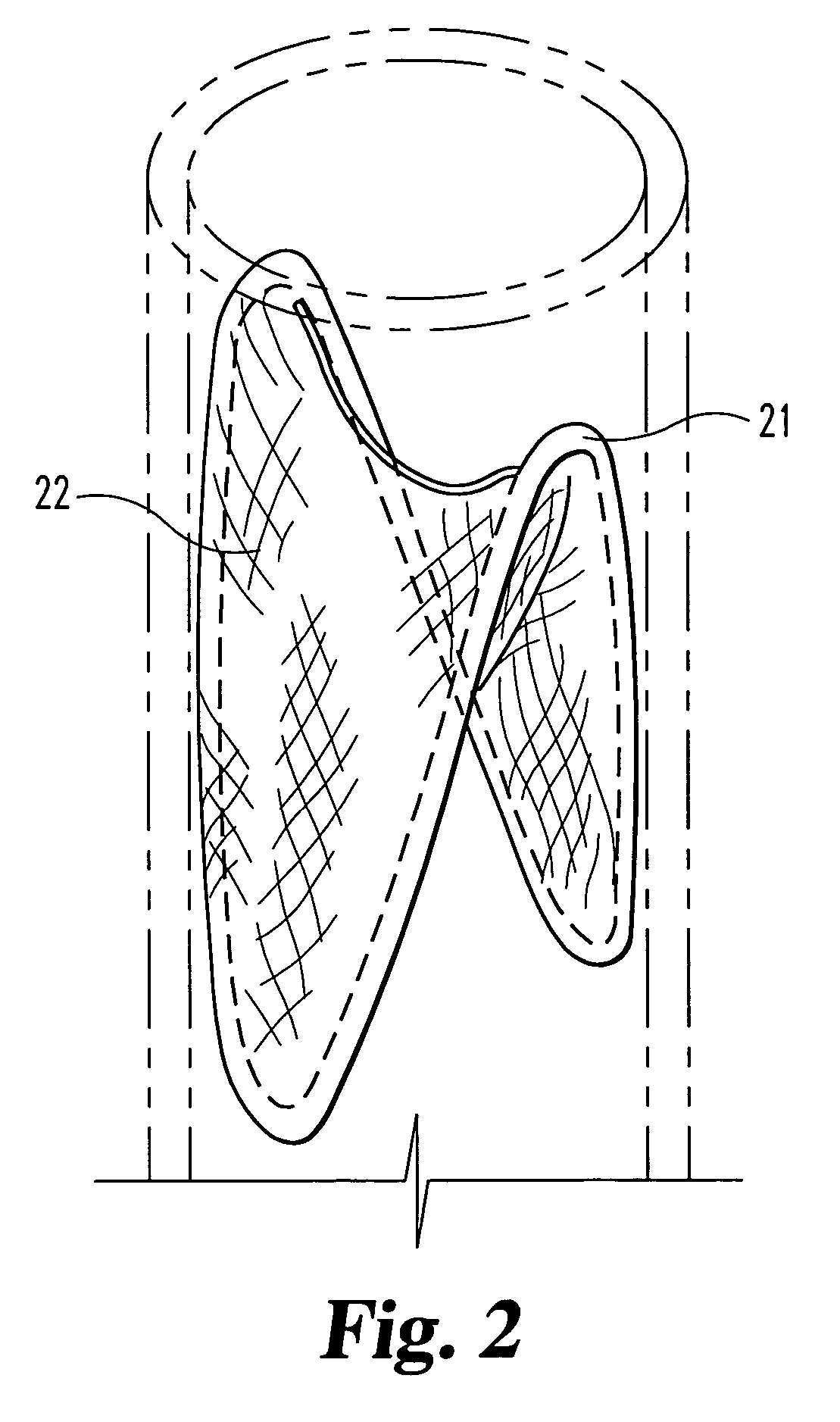 Graft prosthesis devices containing renal capsule collagen