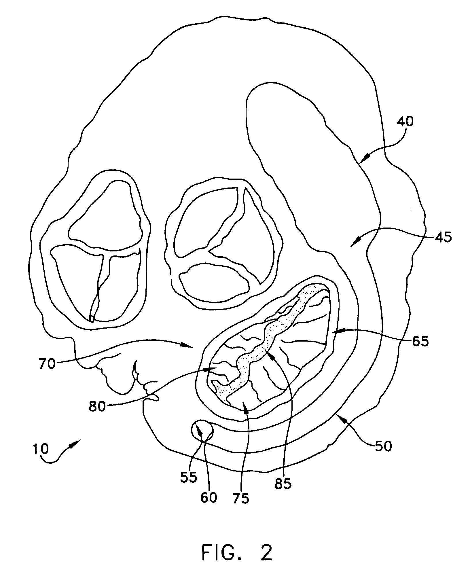 Method and apparatus for improving mitral valve function