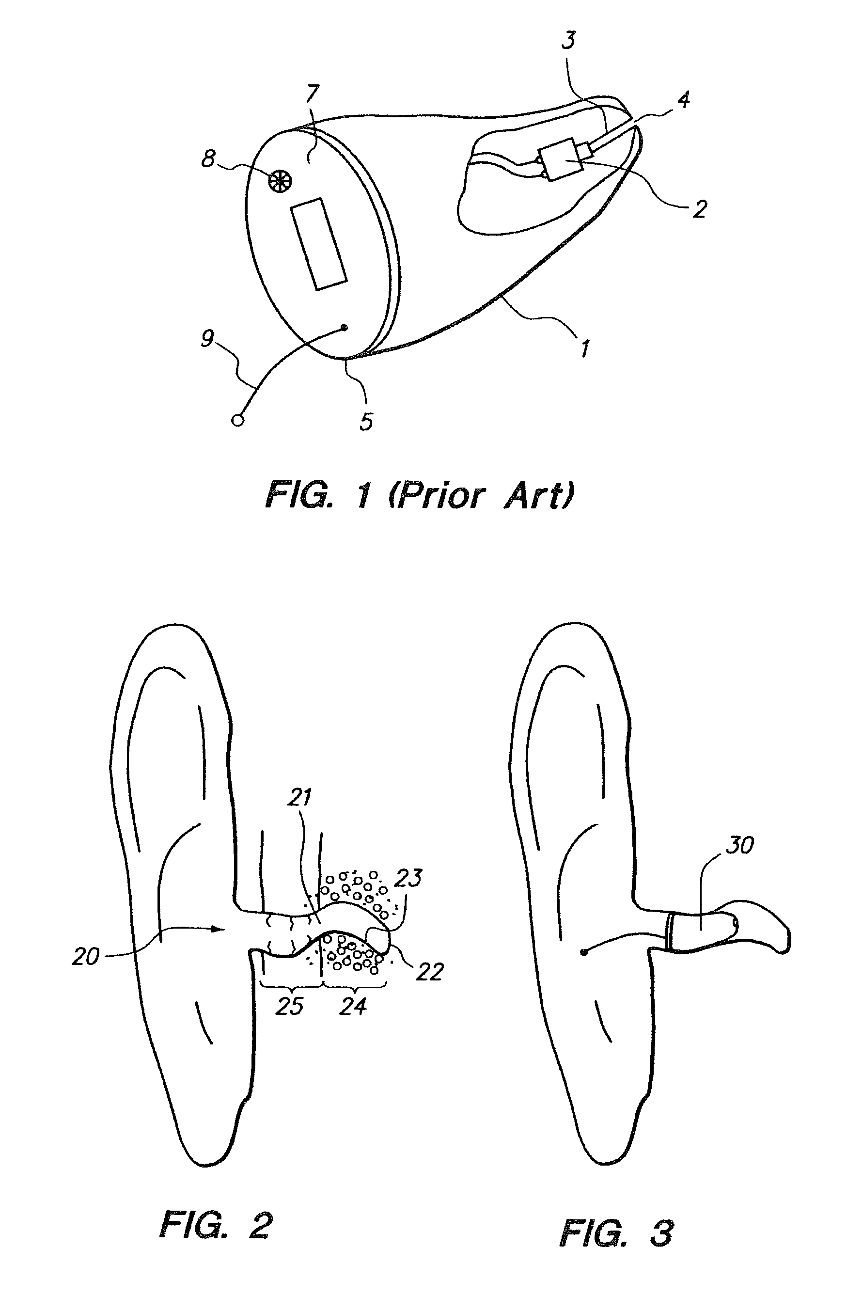 Open fit canal hearing device