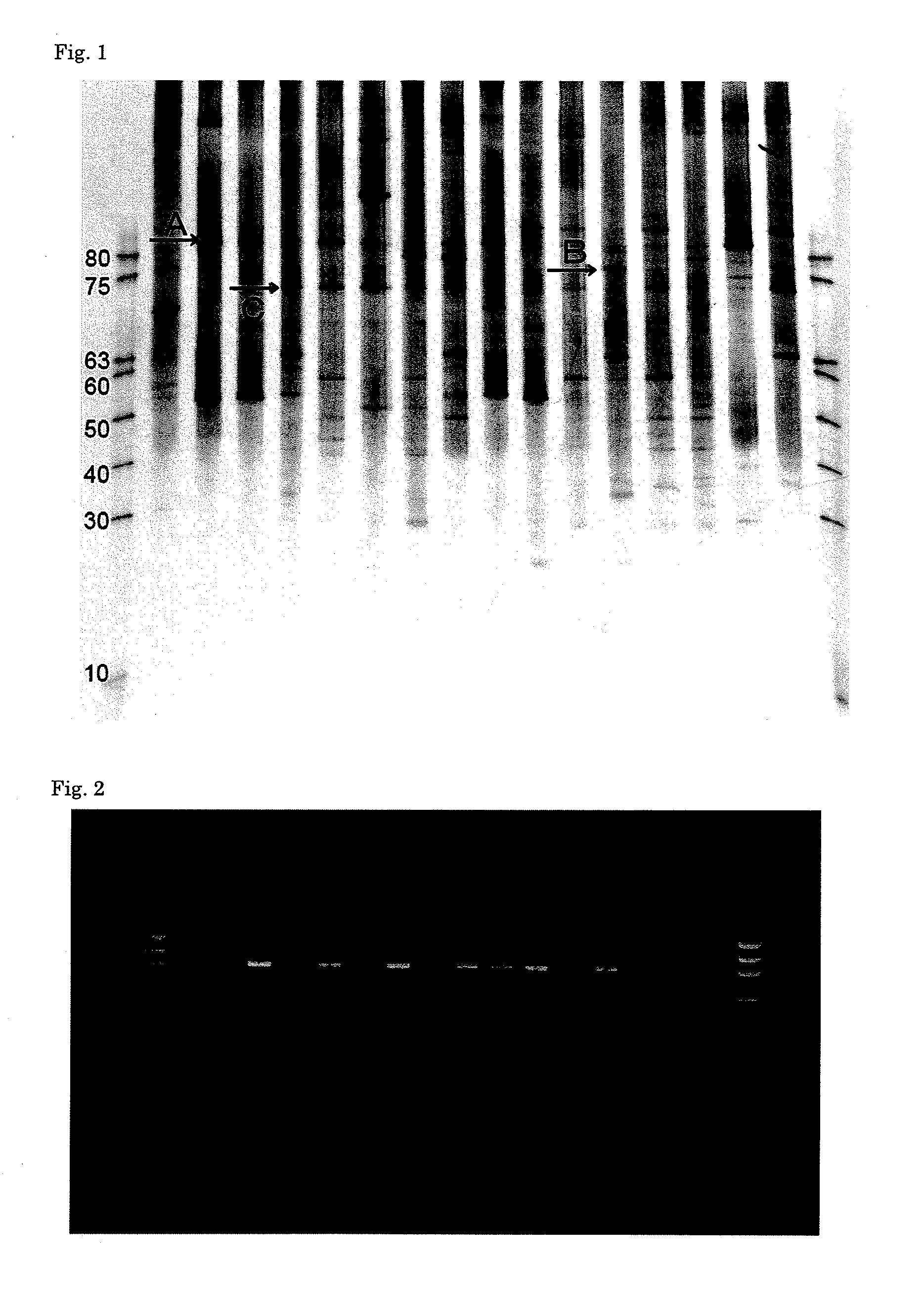 Method for detecting presumed iga nephropathy and method for screening iga nephropathy patients