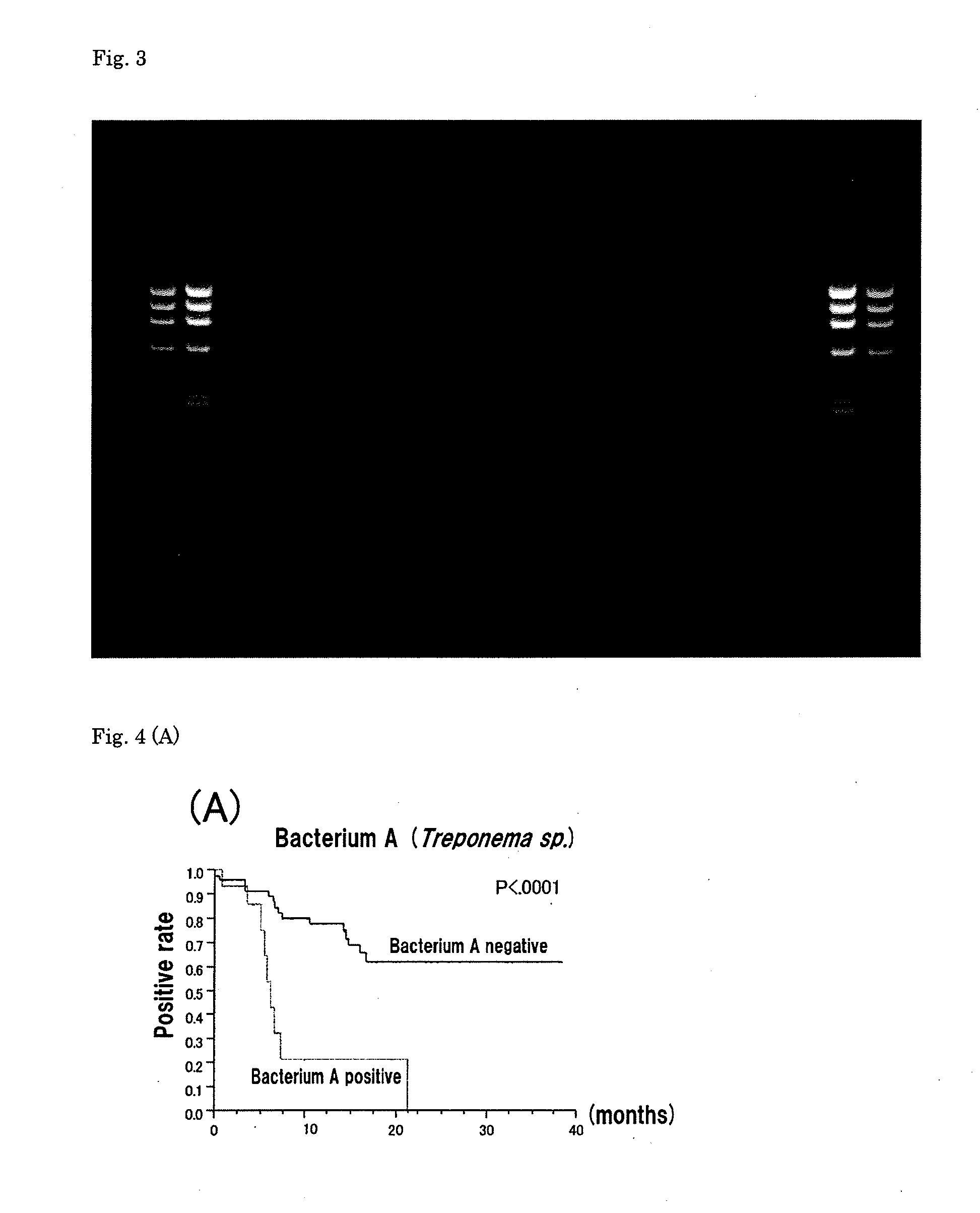 Method for detecting presumed iga nephropathy and method for screening iga nephropathy patients