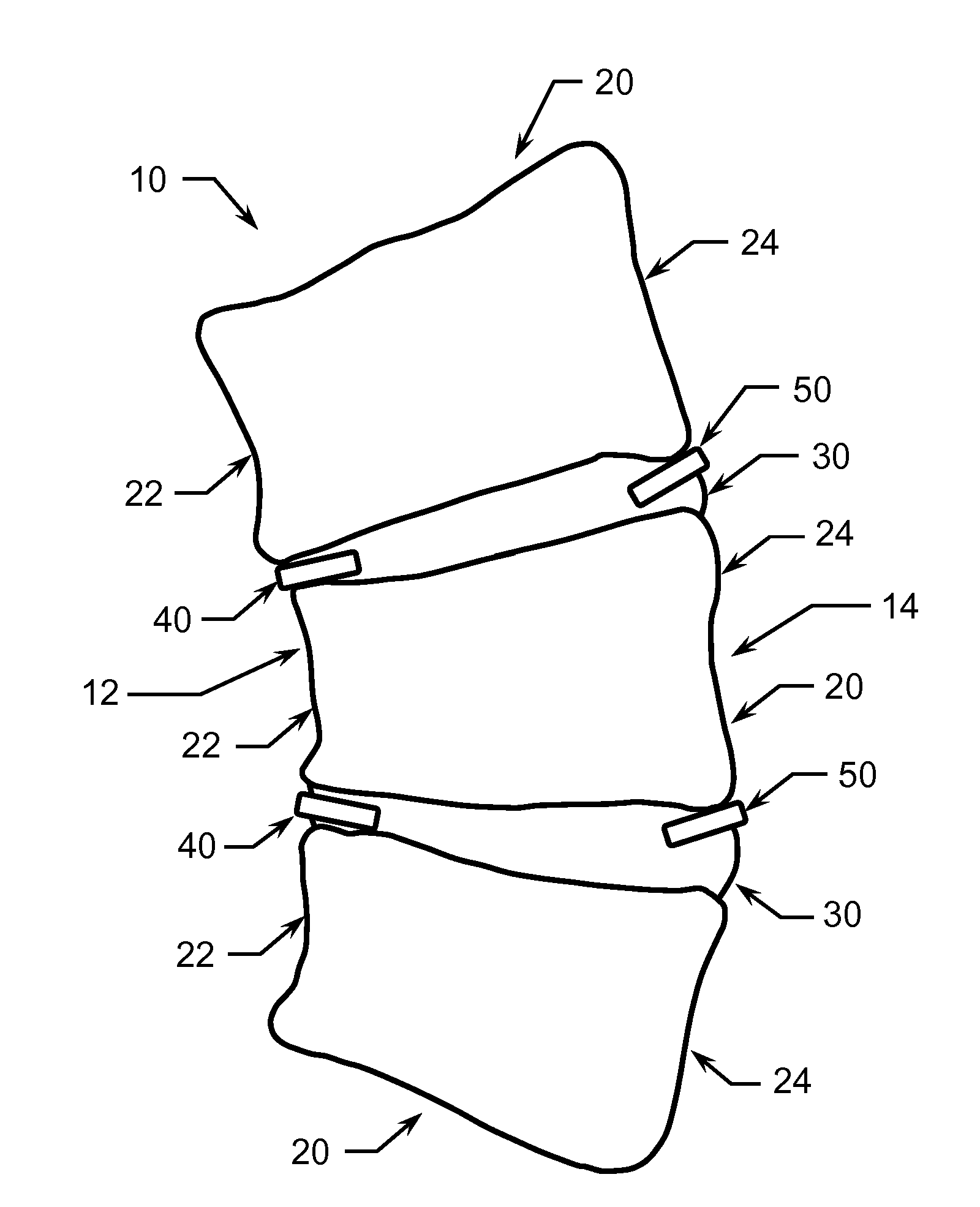 Method of Treating Scoliosis Using a Biological Implant