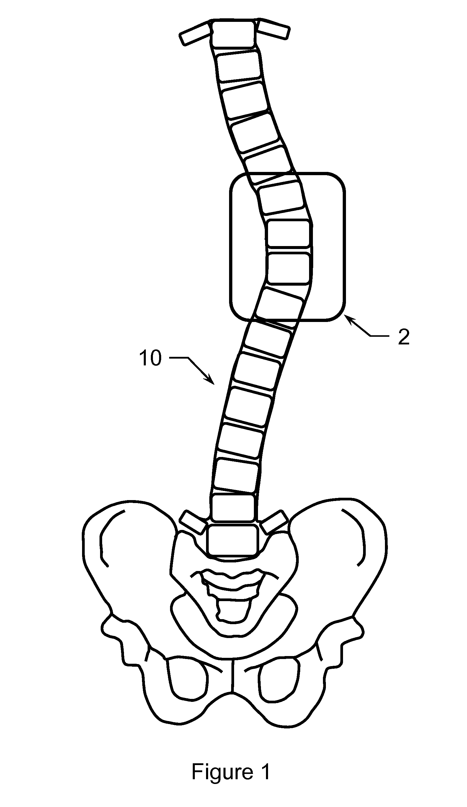 Method of Treating Scoliosis Using a Biological Implant