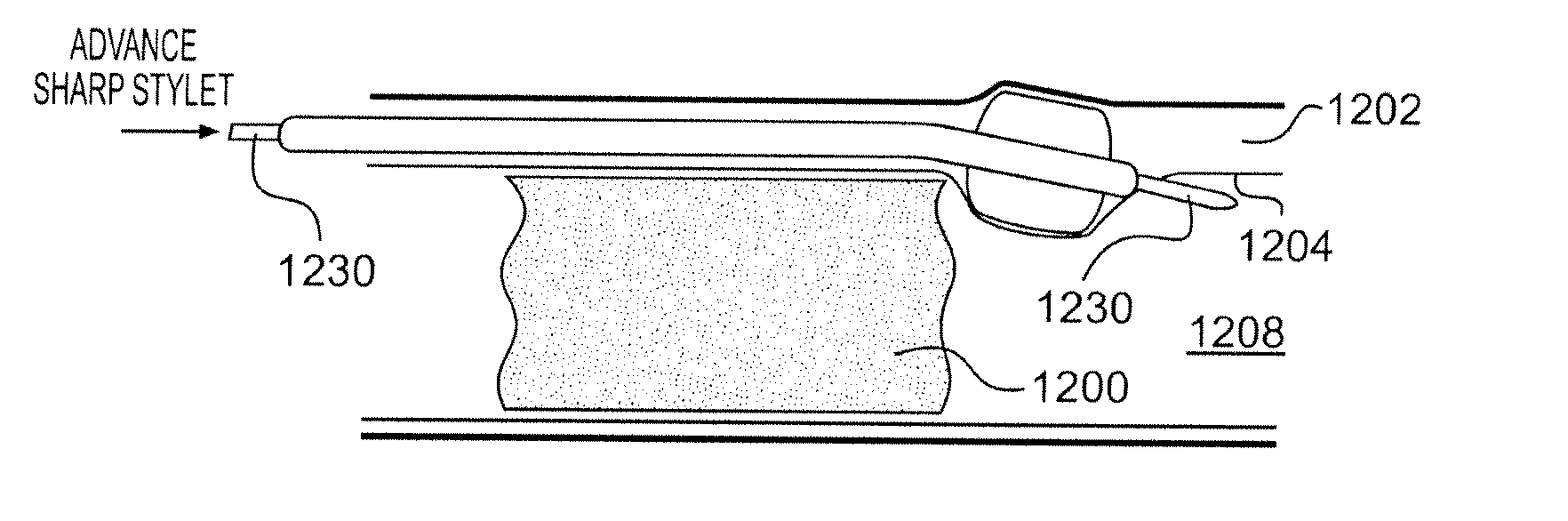 Endovascular devices and methods