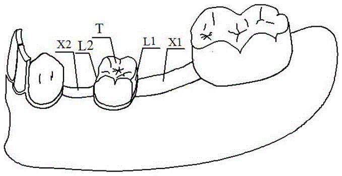 Deciduous tooth spaced shedding space recovering and retaining device