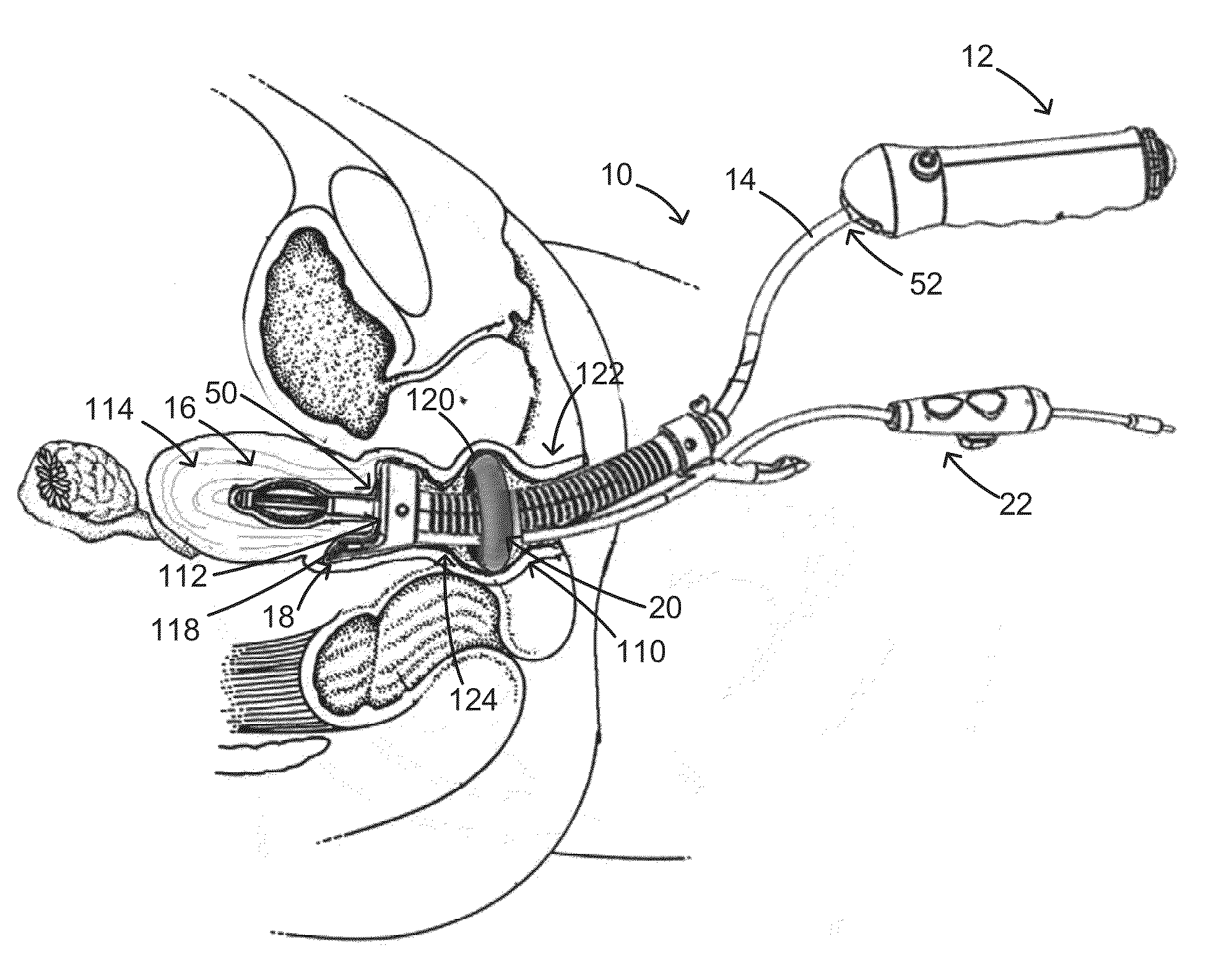 Functional uterine manipulator