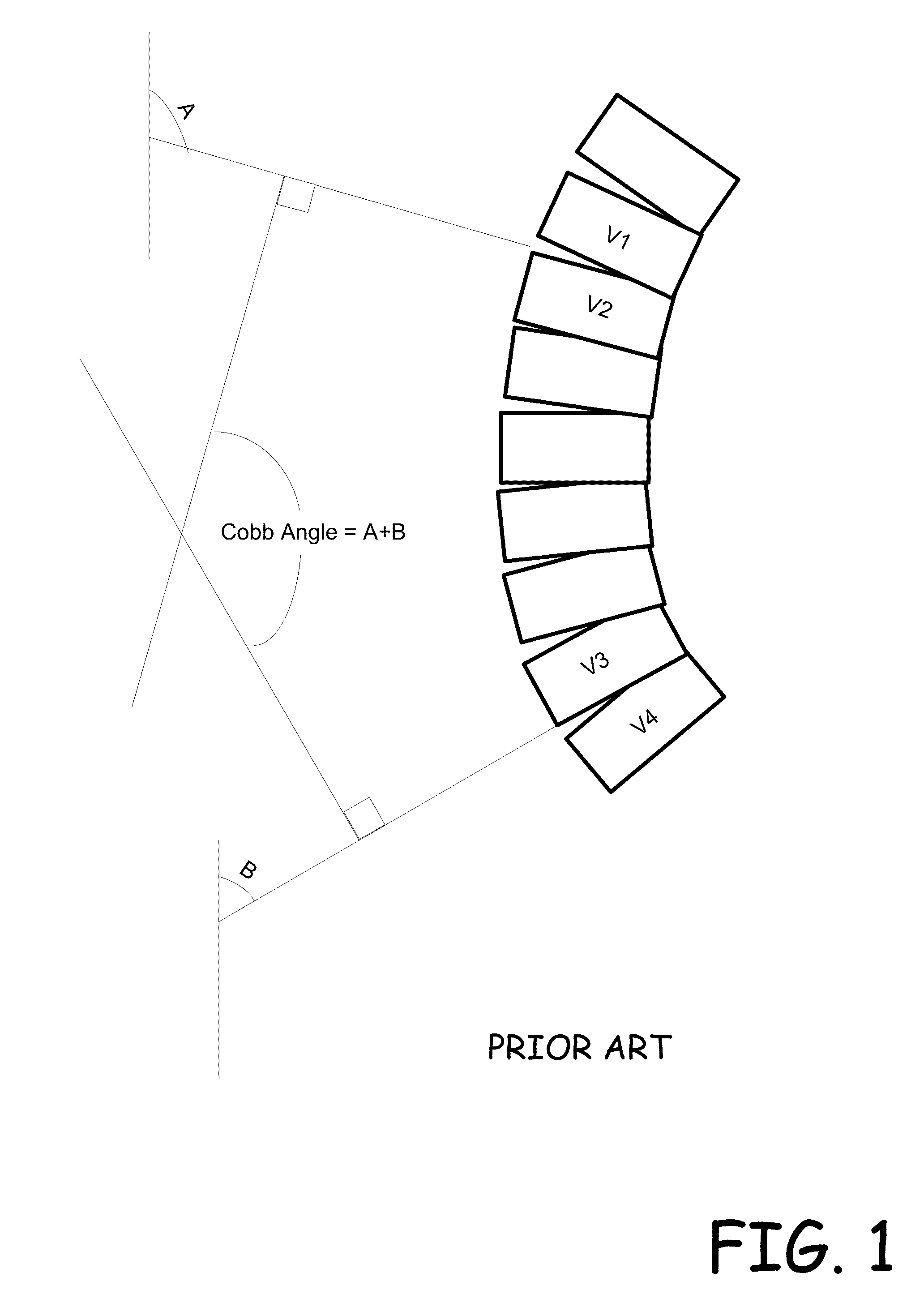 Mobile kyphosis angle measurement