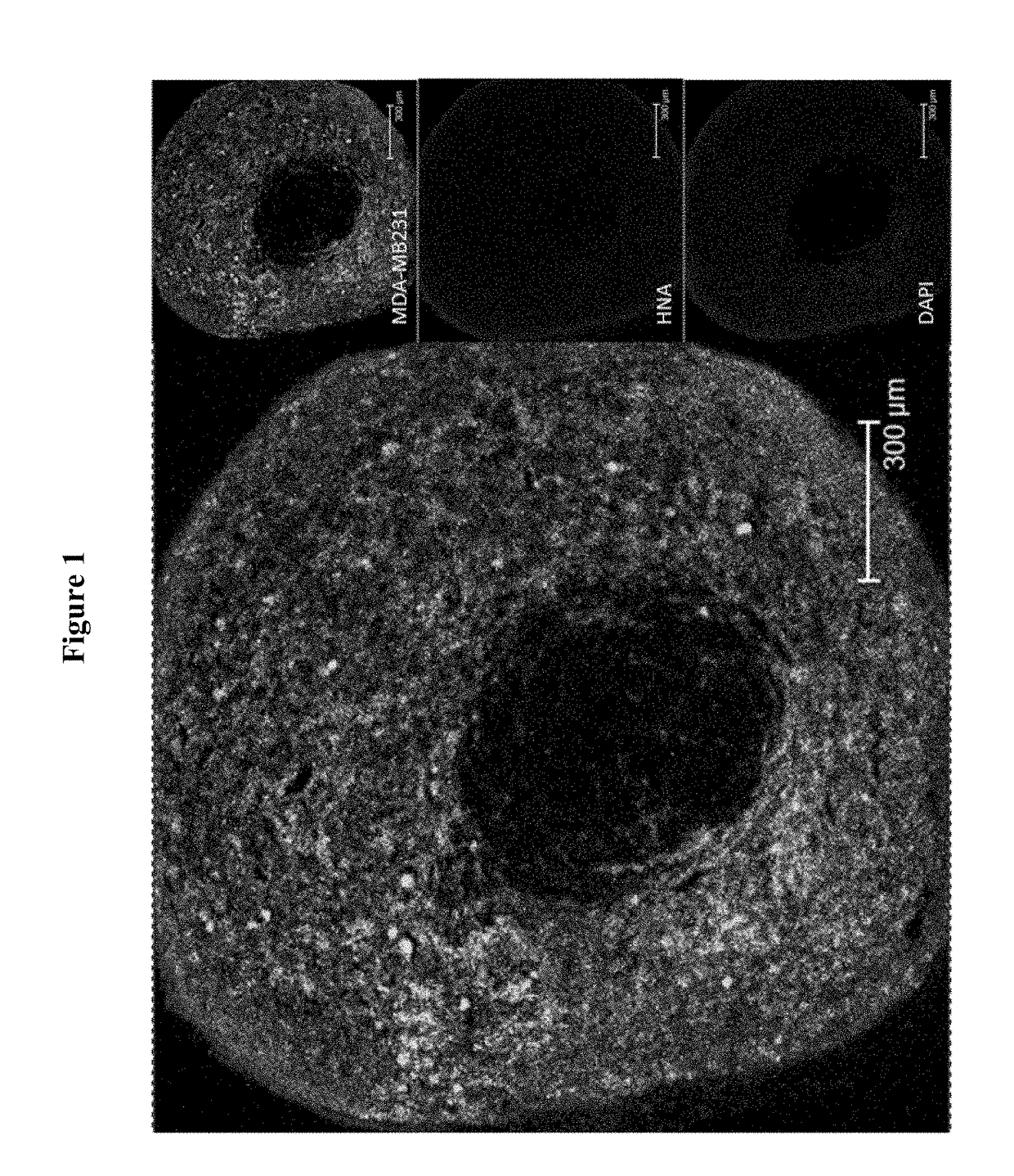 Preventing tumor development and metastasis