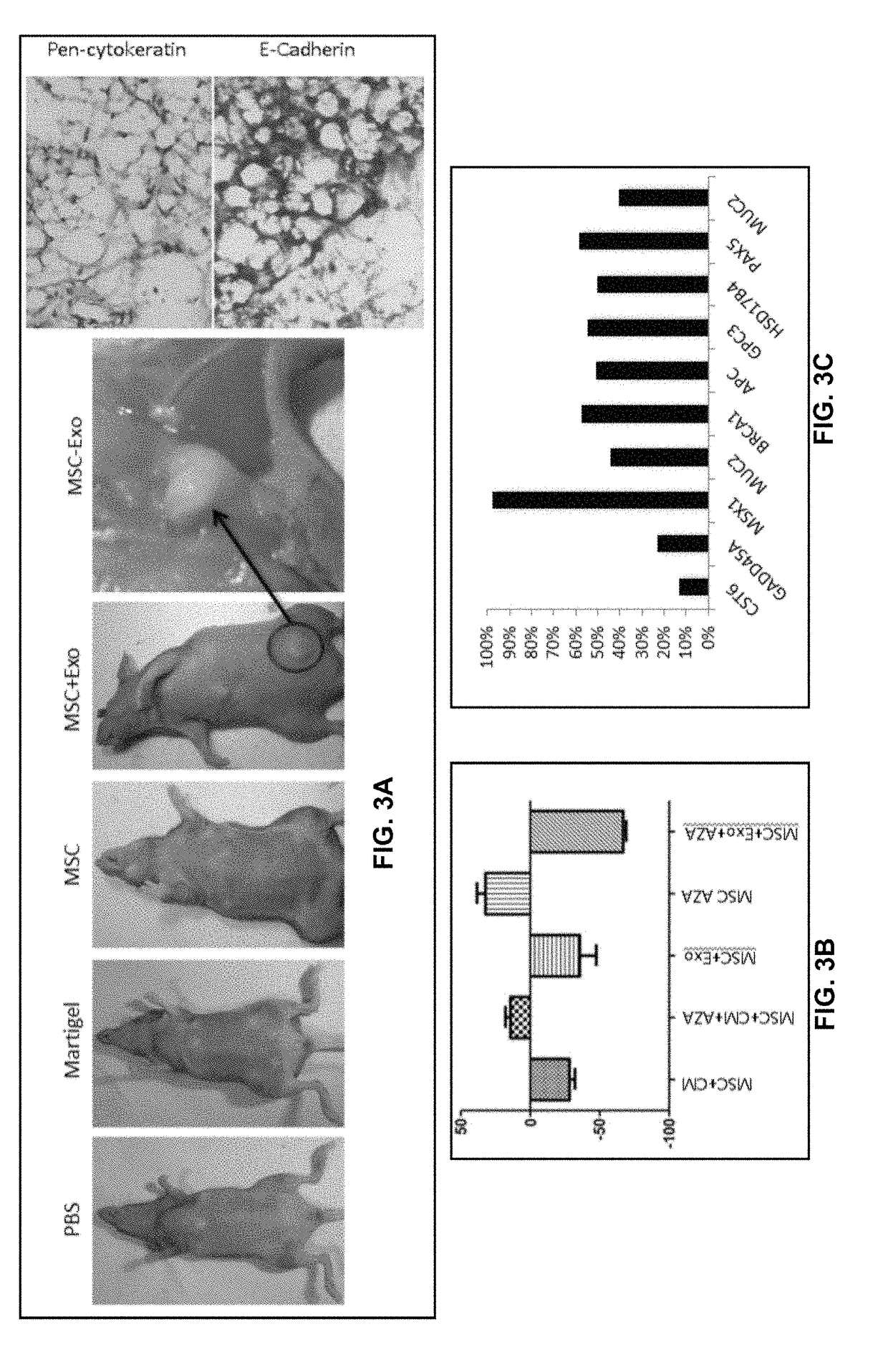 Preventing tumor development and metastasis