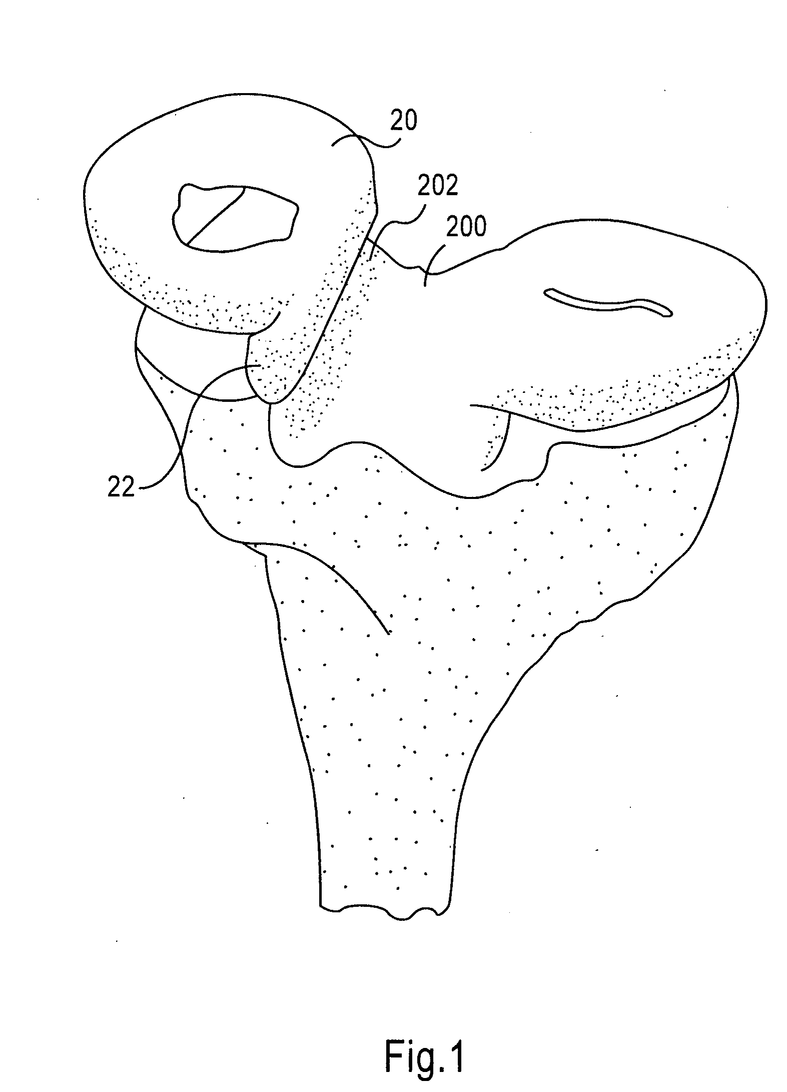 Instrumentation and method for repair of meniscus tissue