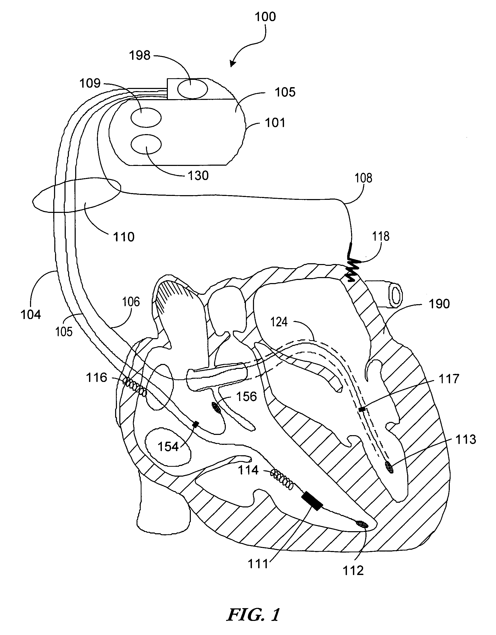 Cardiac template generation based on patient response information