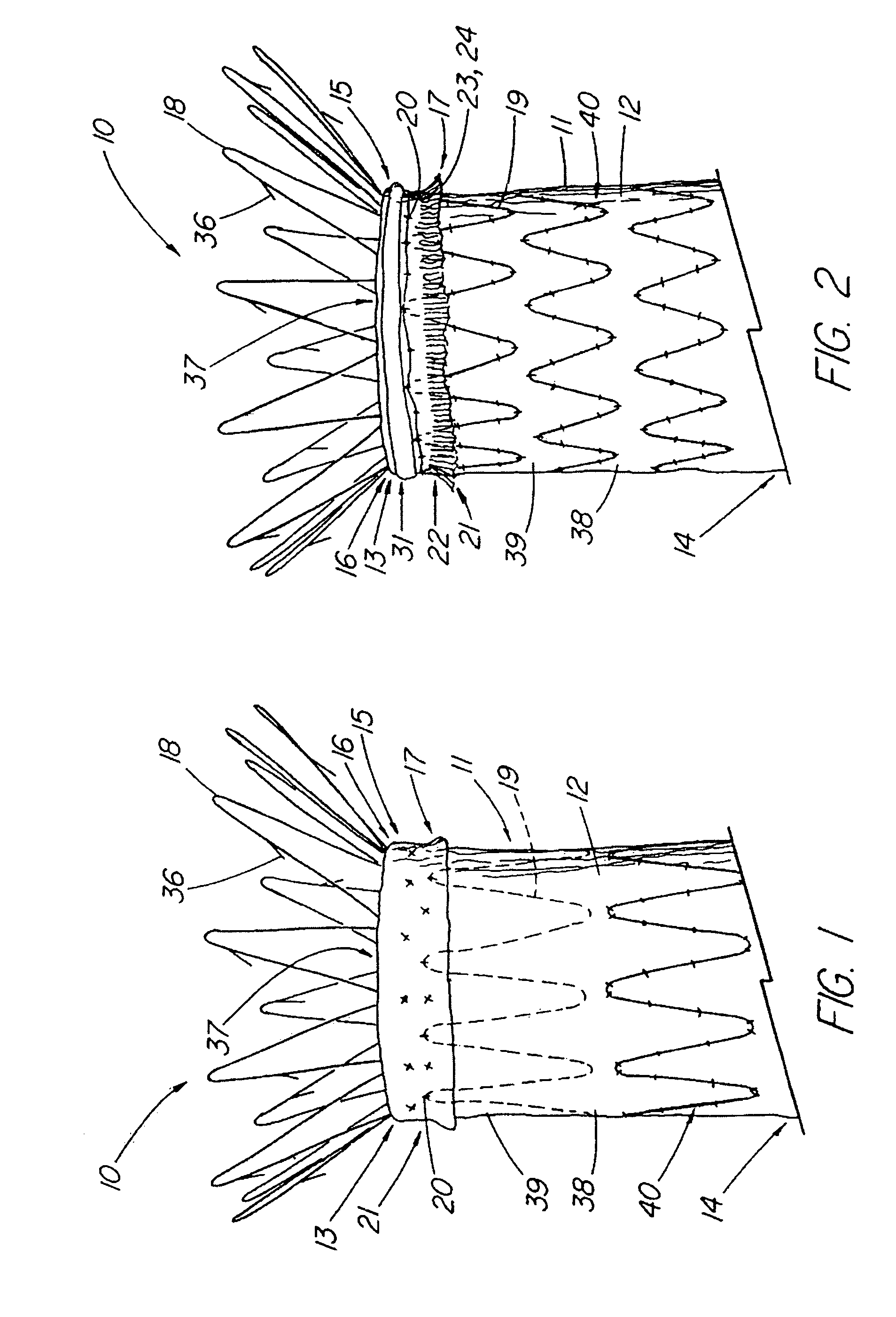 Endoluminal device with extracellular matrix material and methods