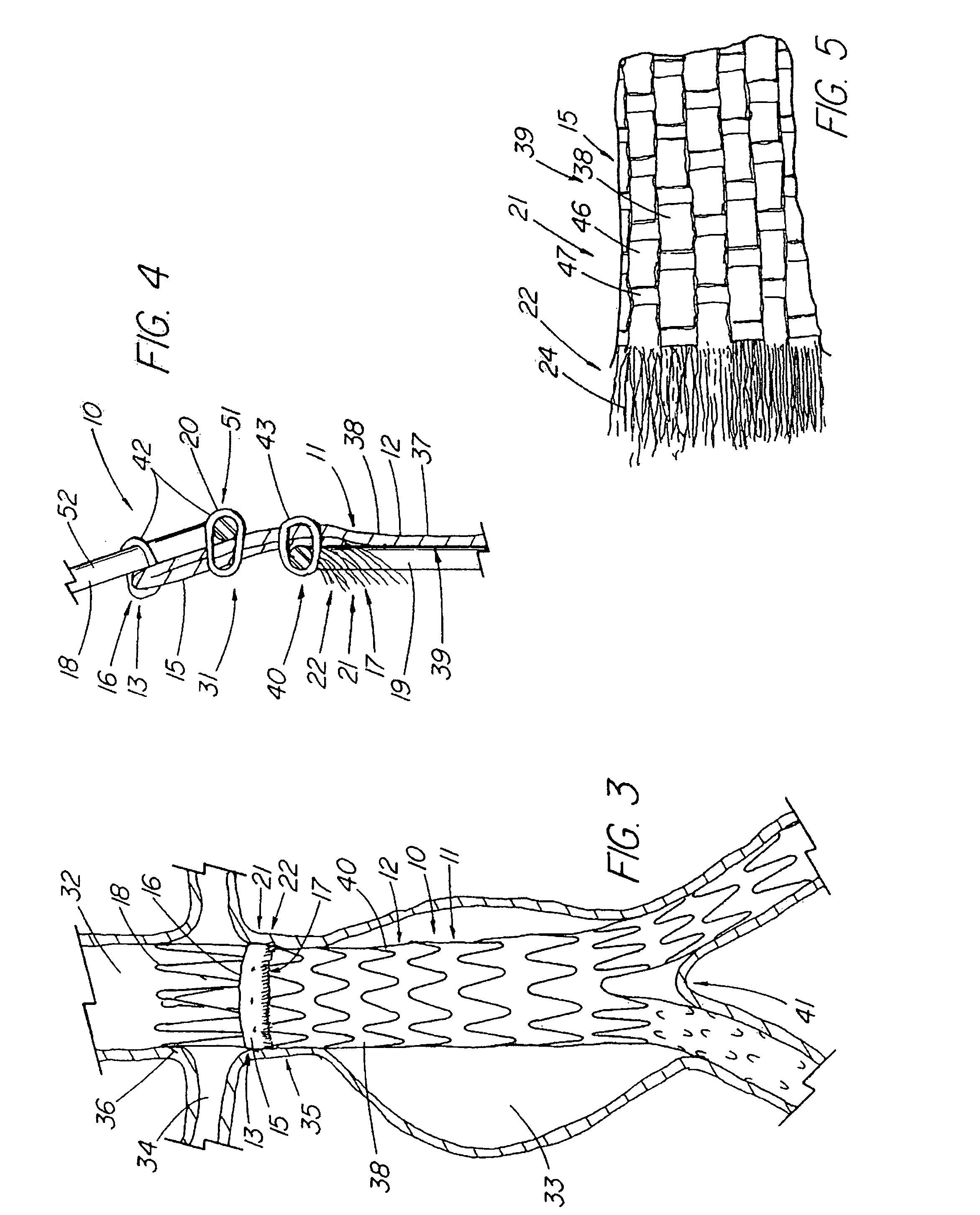 Endoluminal device with extracellular matrix material and methods