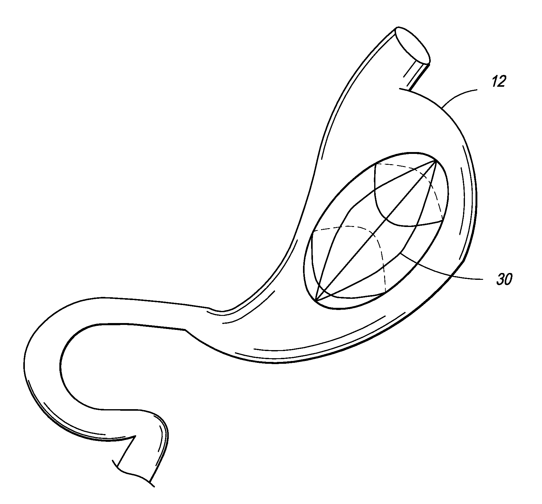 Intragastric Device for Treating Obesity