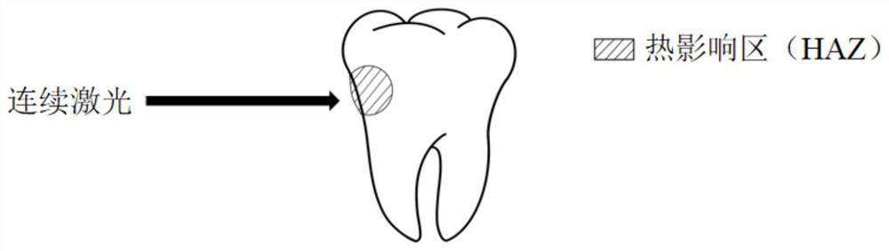 A supragingival scaling device based on high repetition rate femtosecond pulsed laser