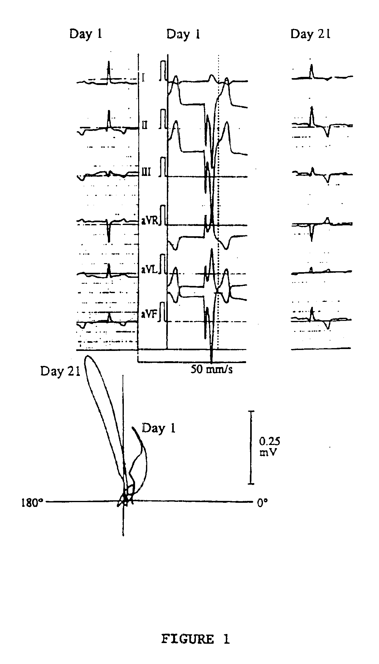 Cardiac remodeling