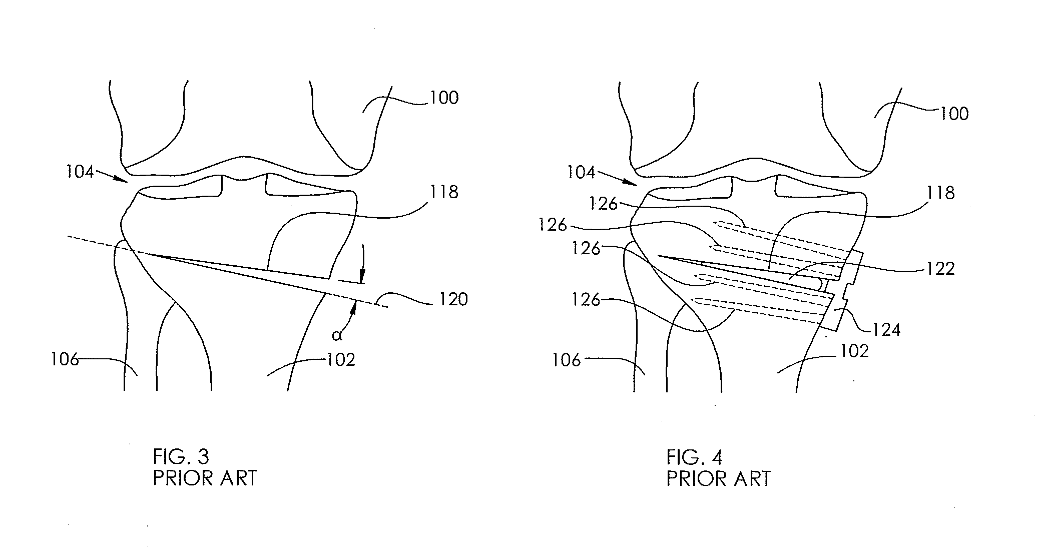 Adjustable devices for treating arthritis of the knee